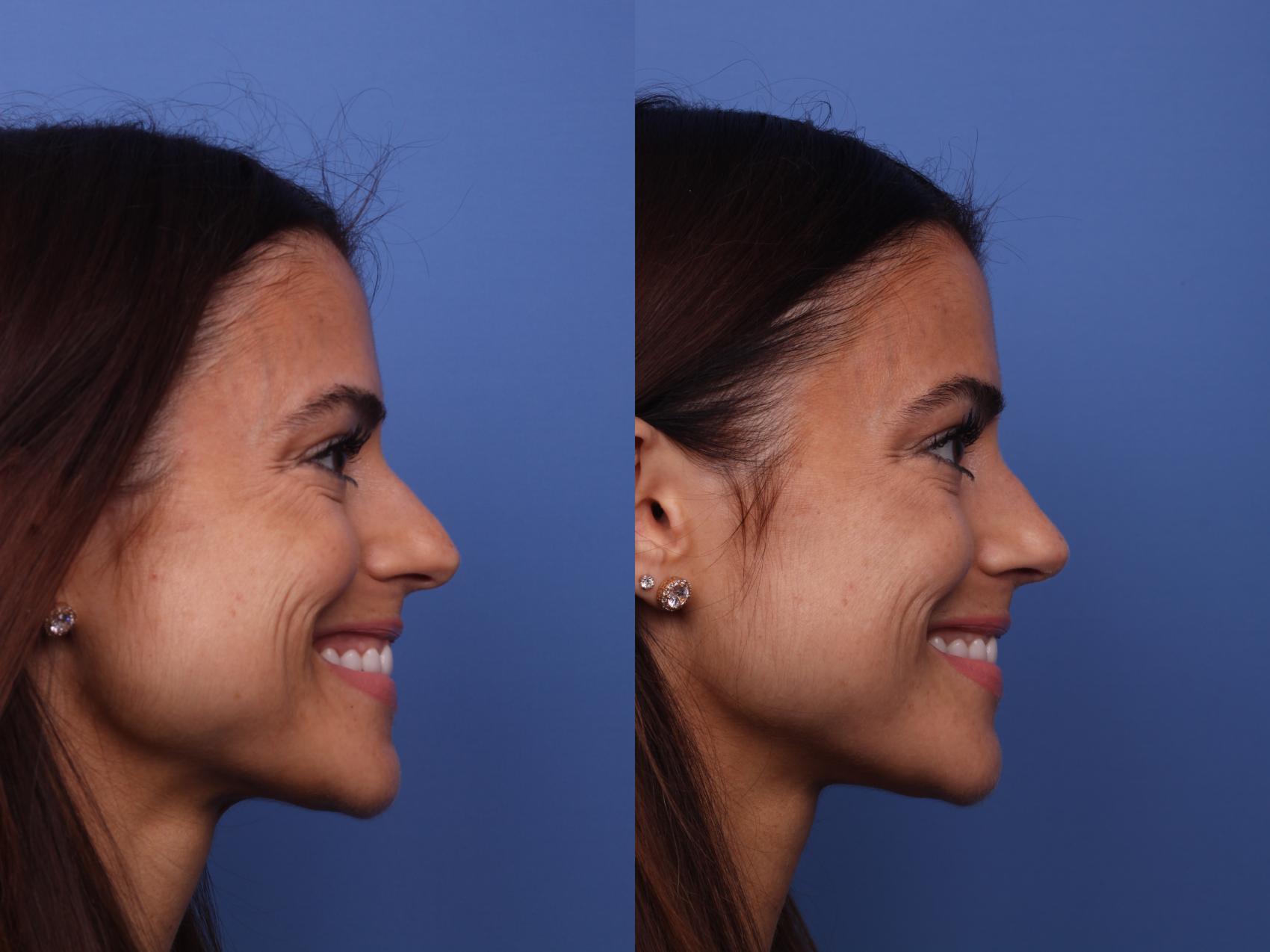 Before & After Rhinoplasty Case 441 Right Smile View in Scottsdale, AZ