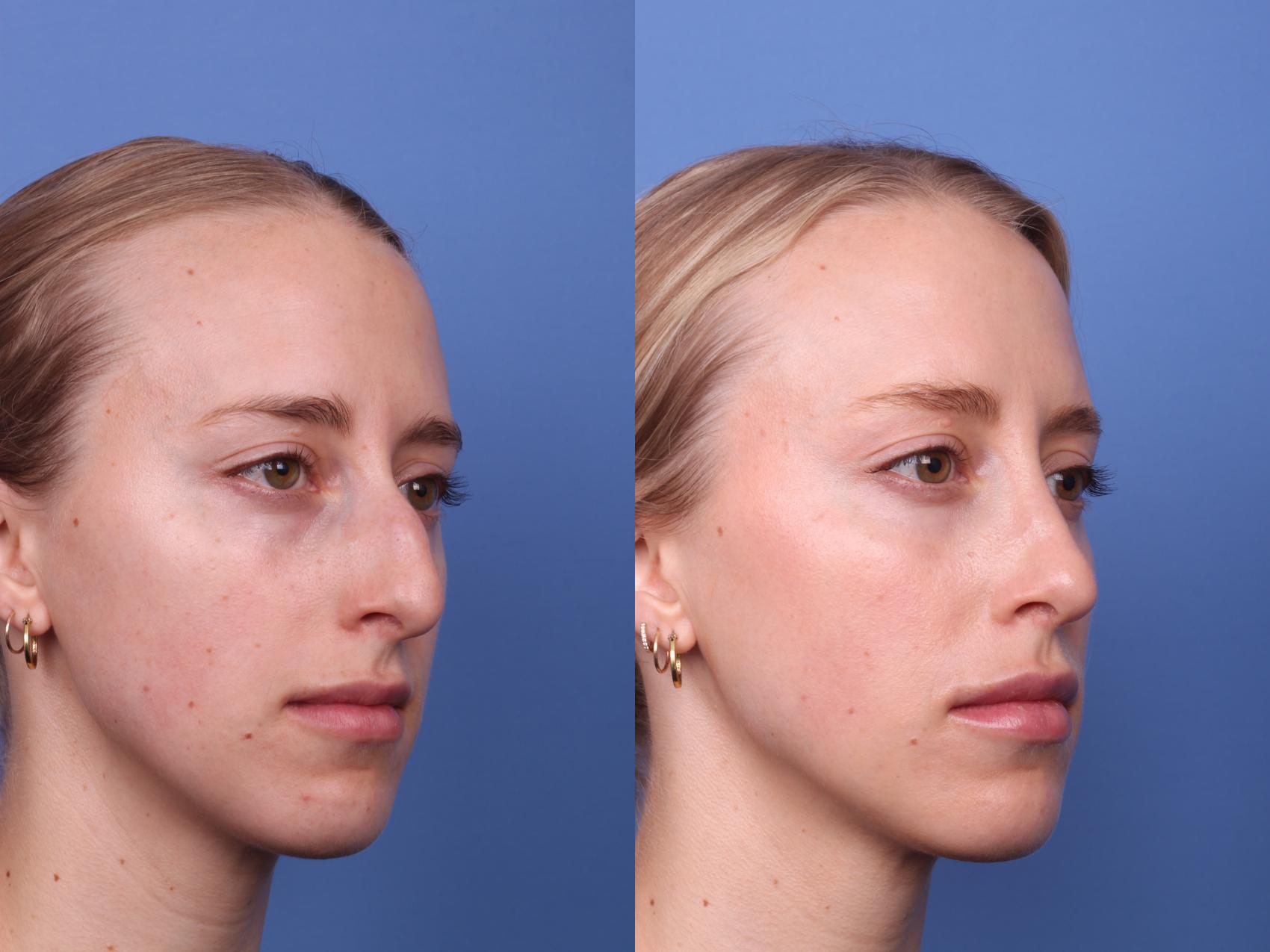 Before & After Rhinoplasty Case 442 Right Oblique View in Scottsdale, AZ