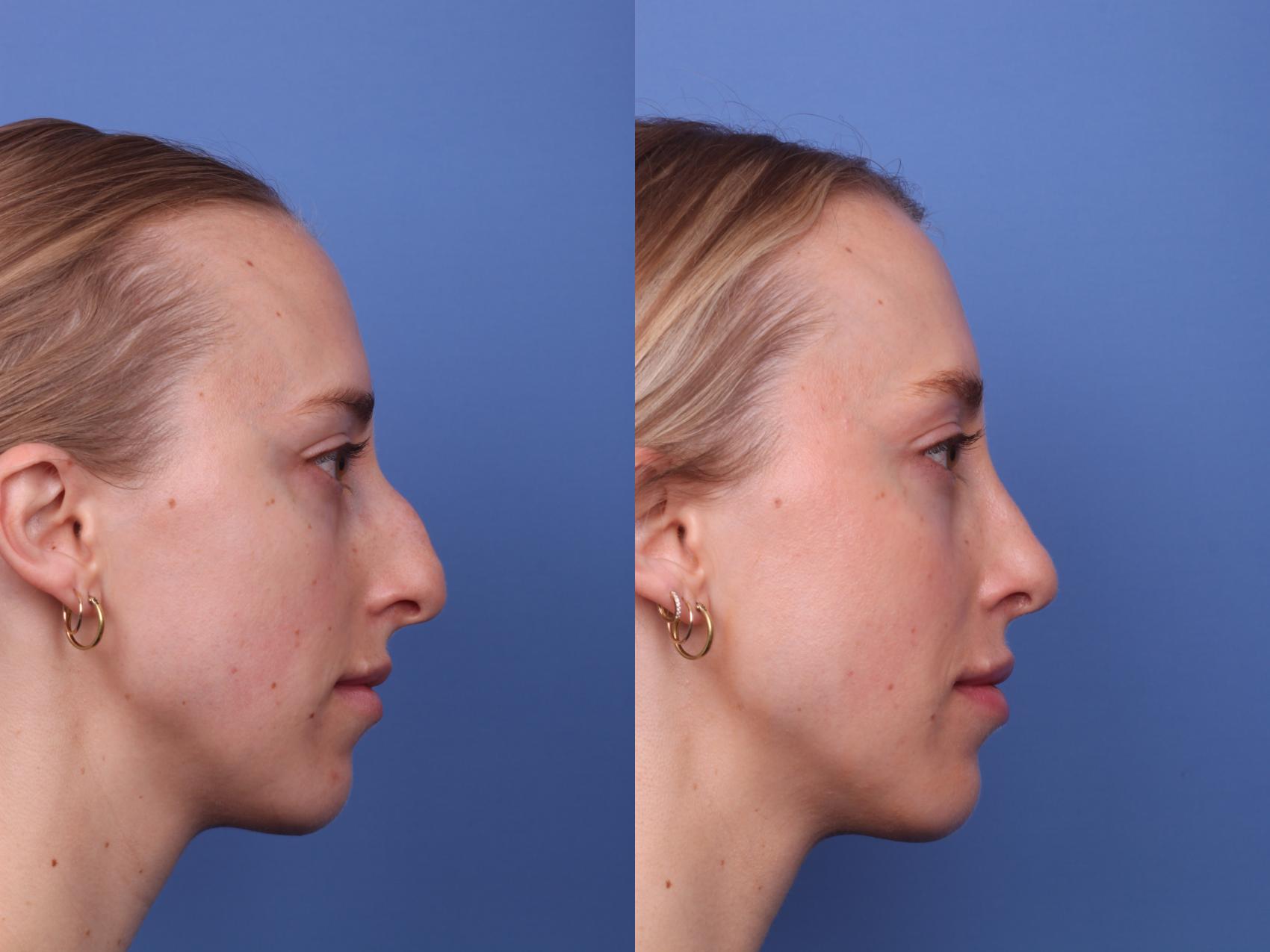 Before & After Rhinoplasty Case 442 Right Side View in Scottsdale, AZ