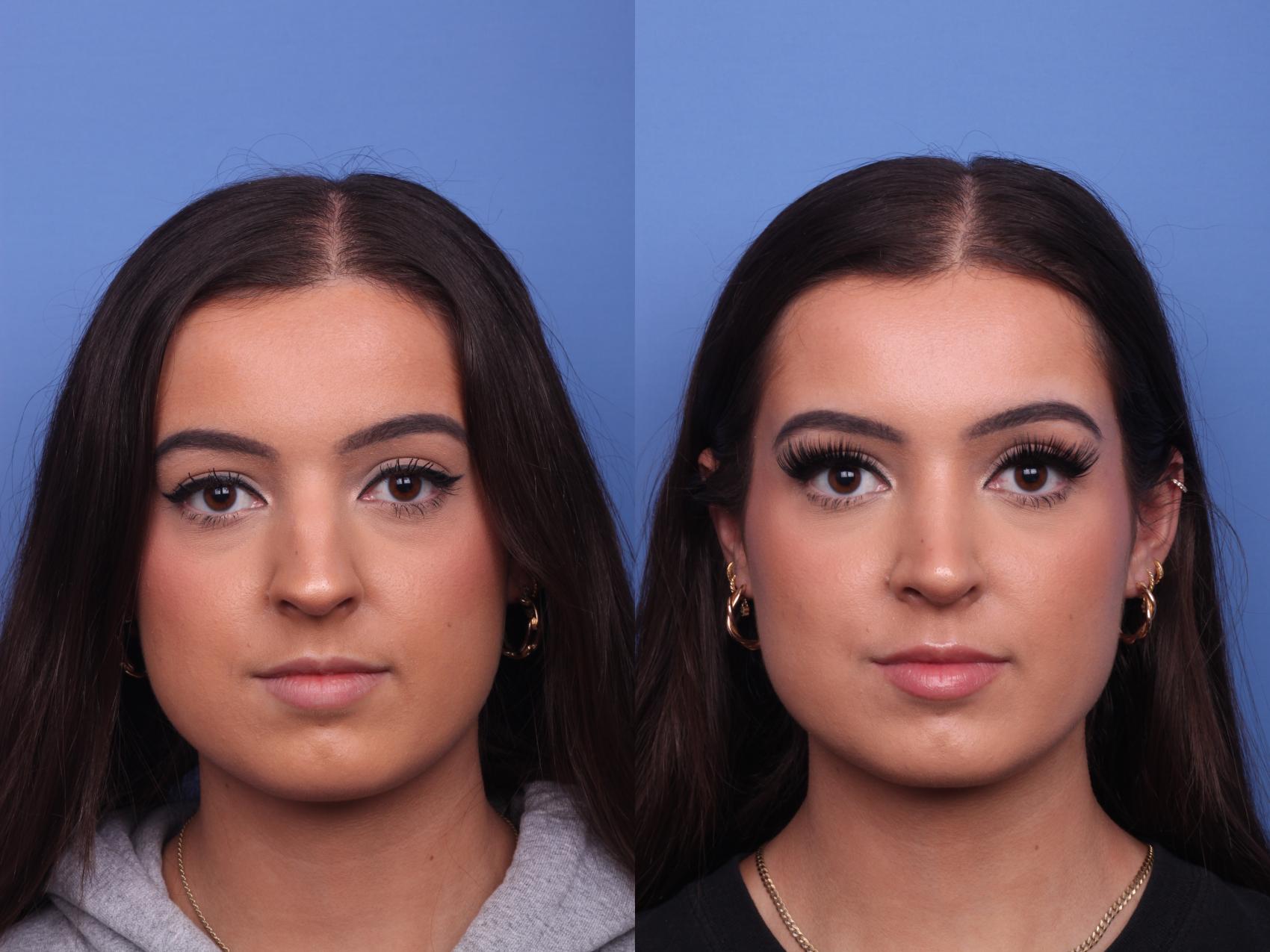 Rhinoplasty Before & After Photo | Scottsdale & Phoenix, AZ | Hobgood Facial Plastic Surgery: Todd Hobgood, MD