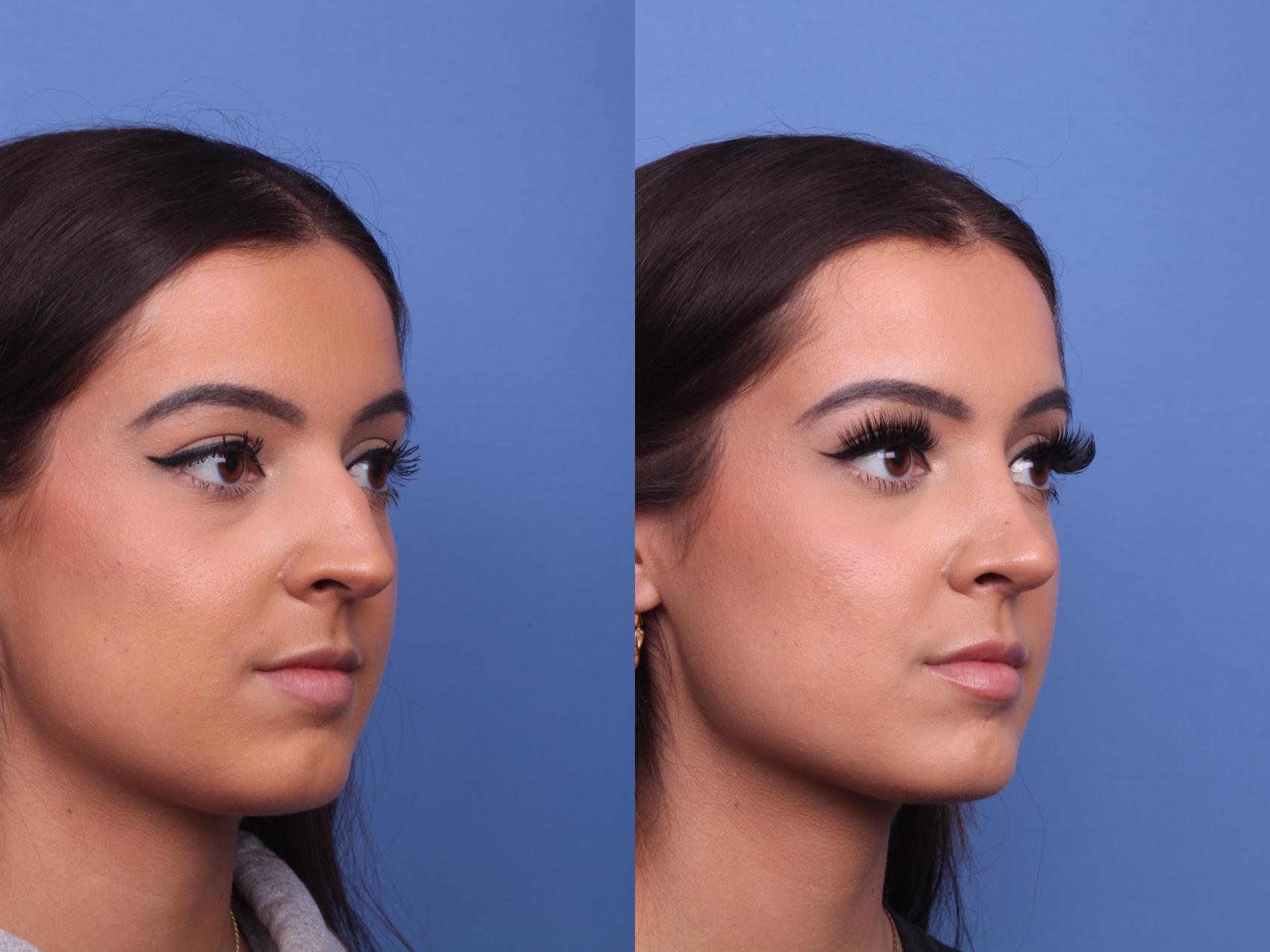 Rhinoplasty Before & After Photo | Scottsdale & Phoenix, AZ | Hobgood Facial Plastic Surgery: Todd Hobgood, MD