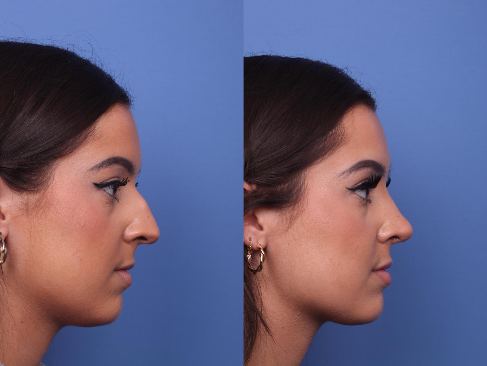 Rhinoplasty Before & After Photo | Scottsdale & Phoenix, AZ | Hobgood Facial Plastic Surgery: Todd Hobgood, MD