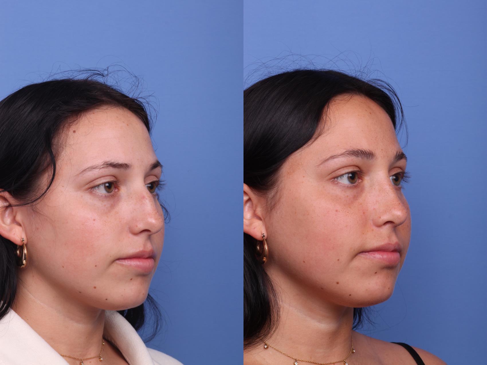 Before & After Rhinoplasty Case 448 Right Oblique View in Scottsdale, AZ