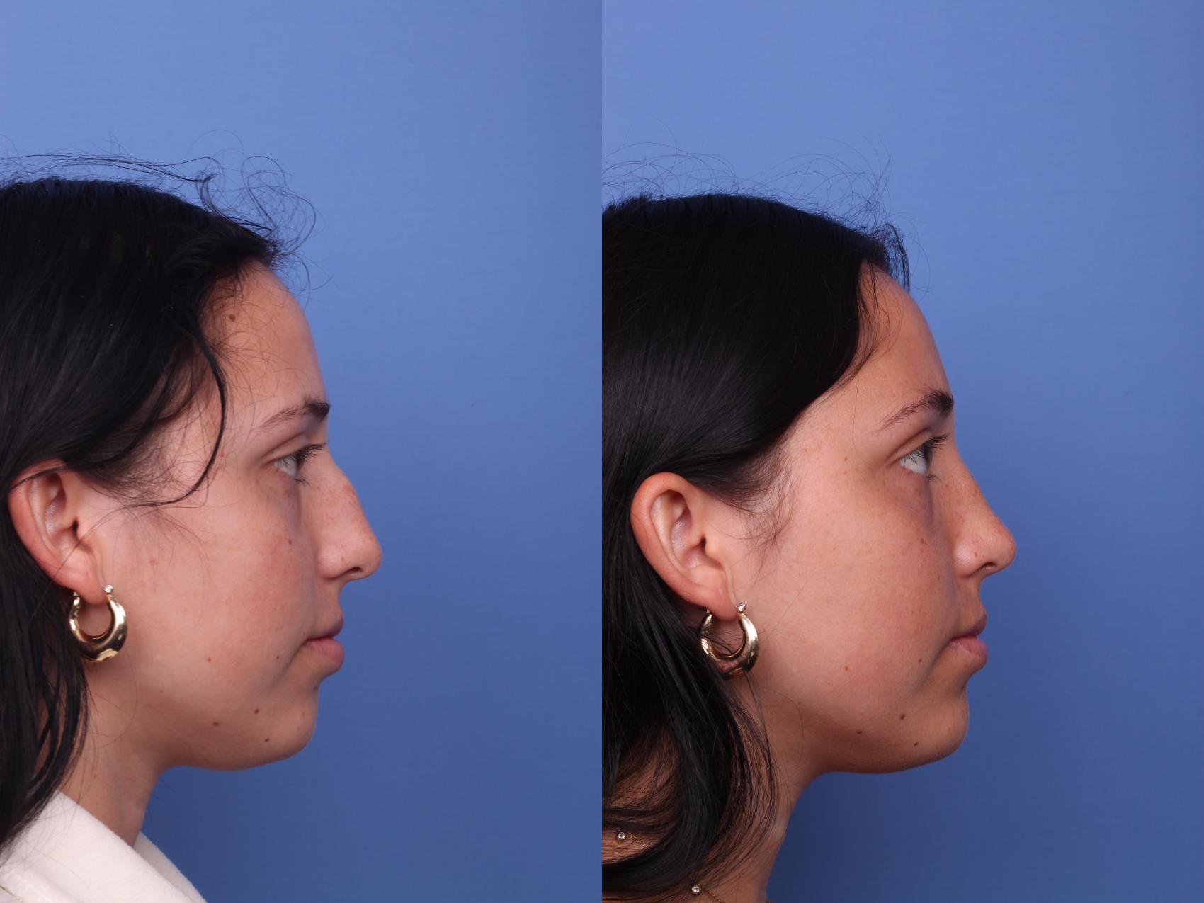 Before & After Rhinoplasty Case 448 Right Side View in Scottsdale, AZ