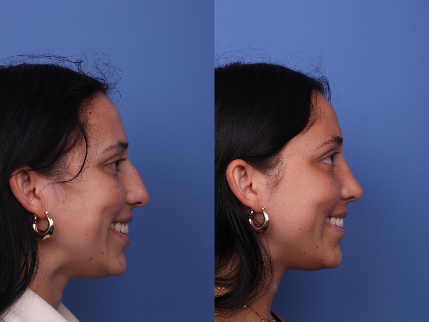 Before & After Rhinoplasty Case 448 Right Smile View in Scottsdale, AZ