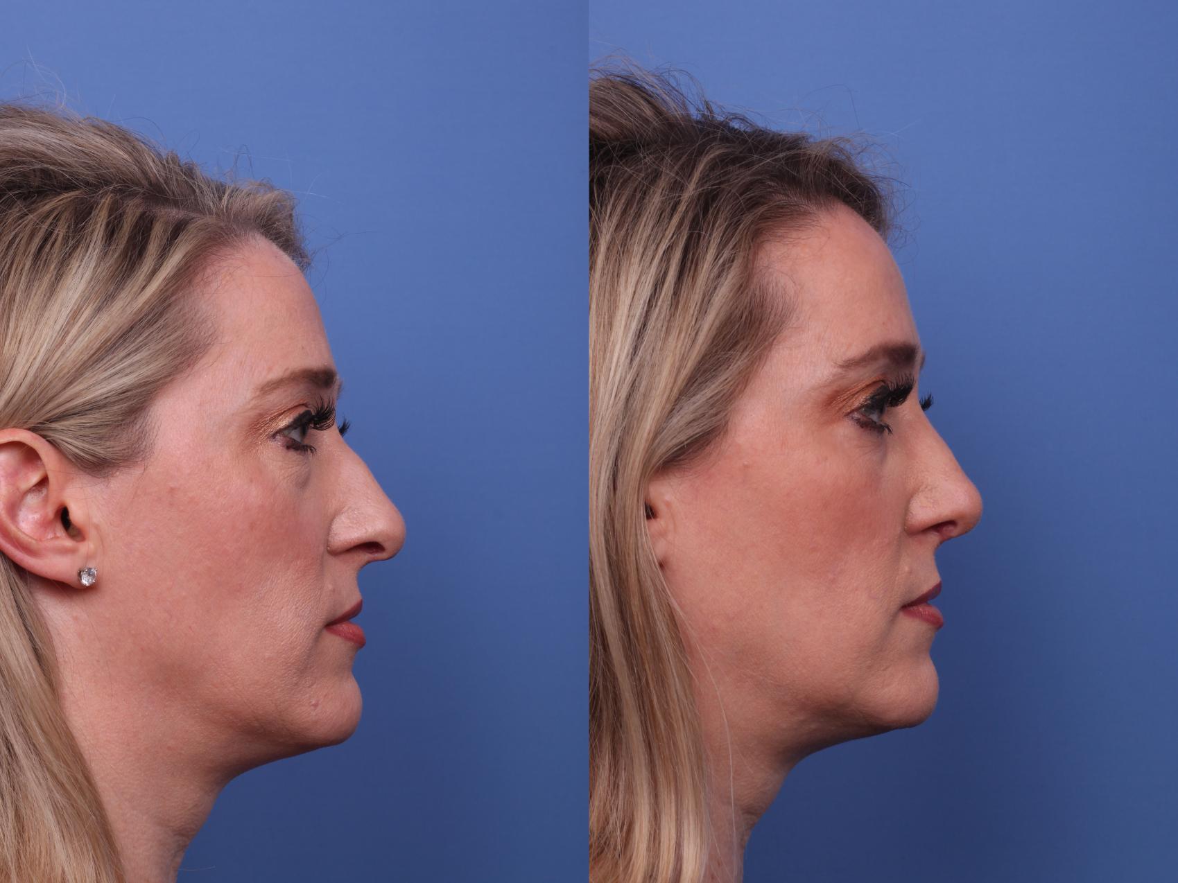 Before & After Rhinoplasty Case 449 Right Side View in Scottsdale, AZ