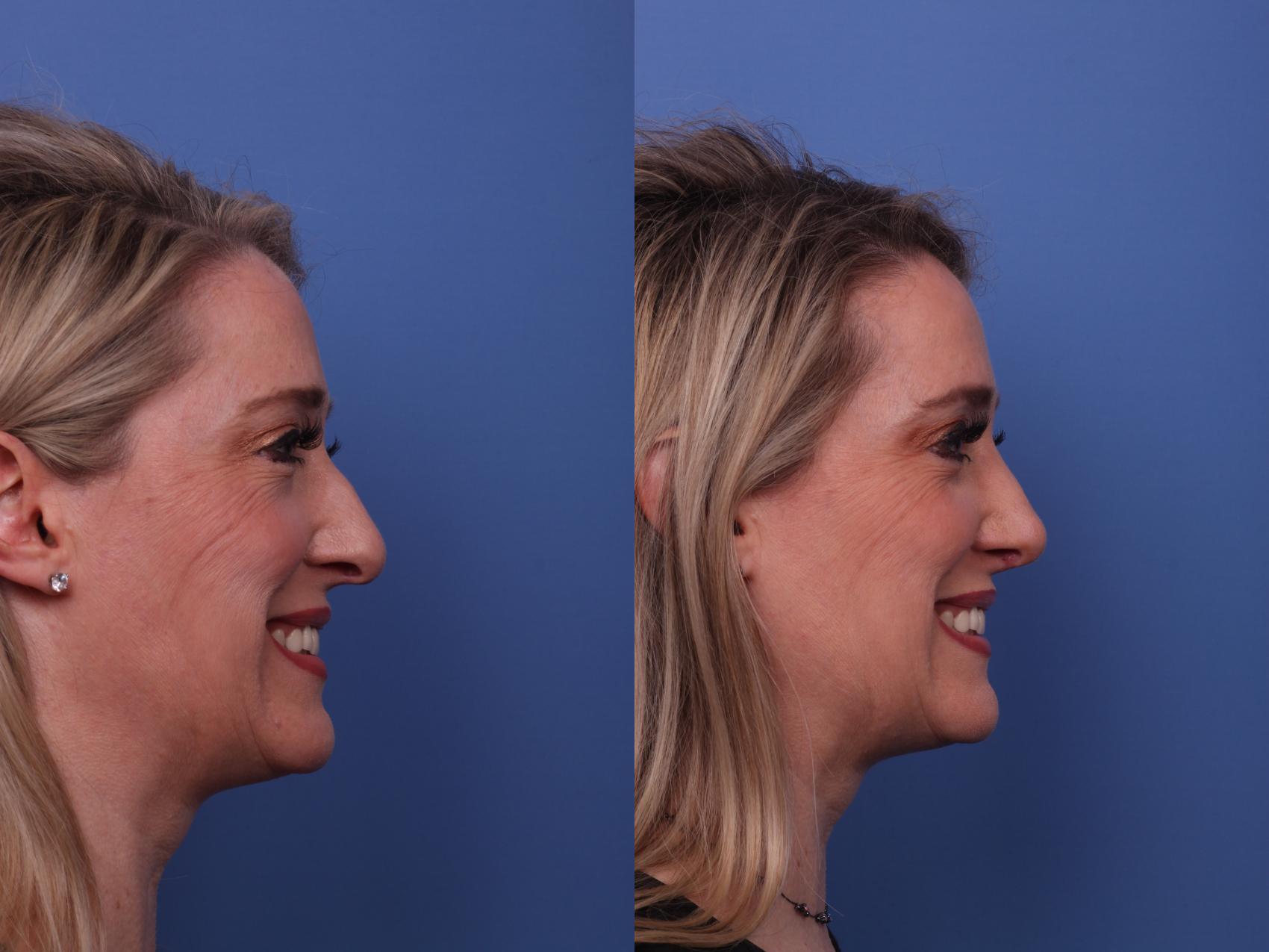 Before & After Rhinoplasty Case 449 Right Smile View in Scottsdale, AZ