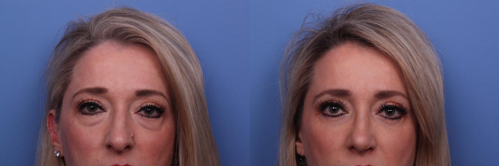 Before & After Rhinoplasty Case 449 Zoom Bleph View in Scottsdale, AZ