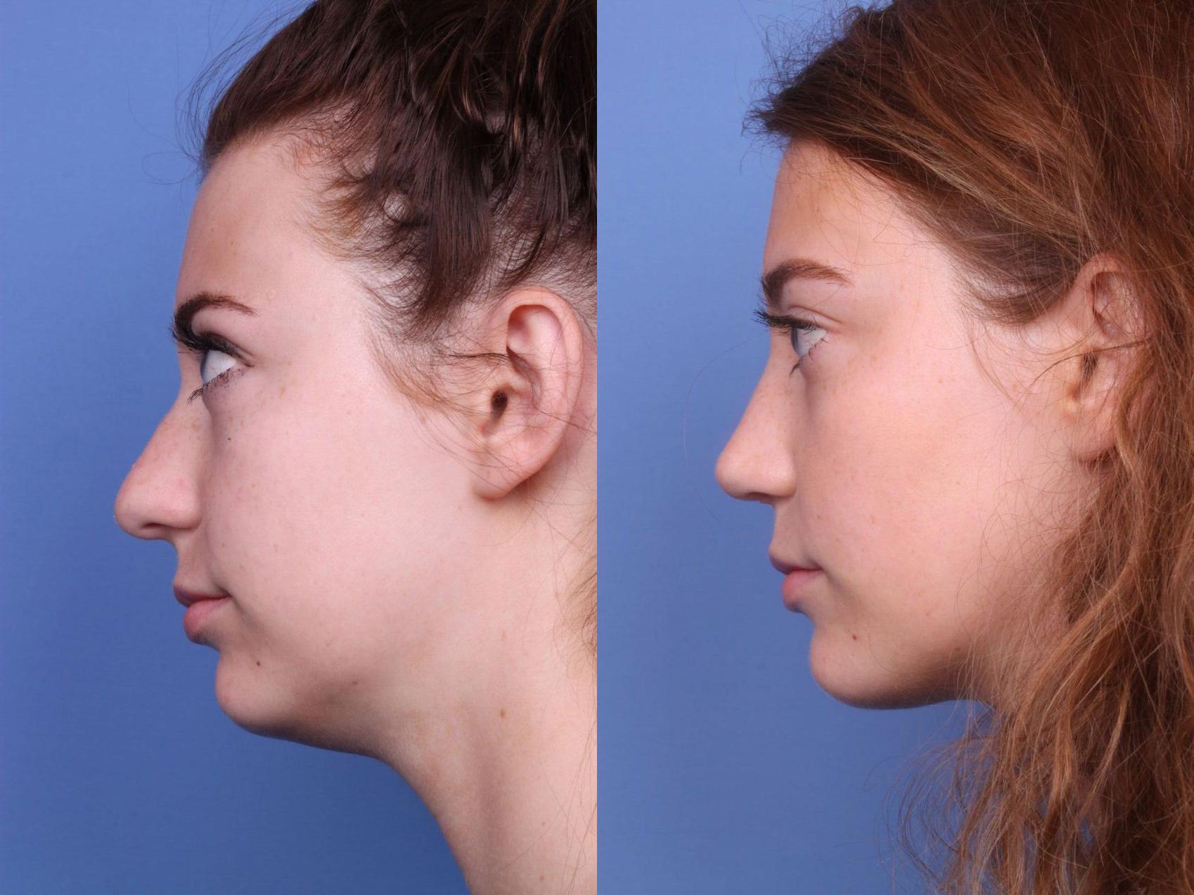 Before & After Rhinoplasty Case 45 View #2 View in Scottsdale, AZ