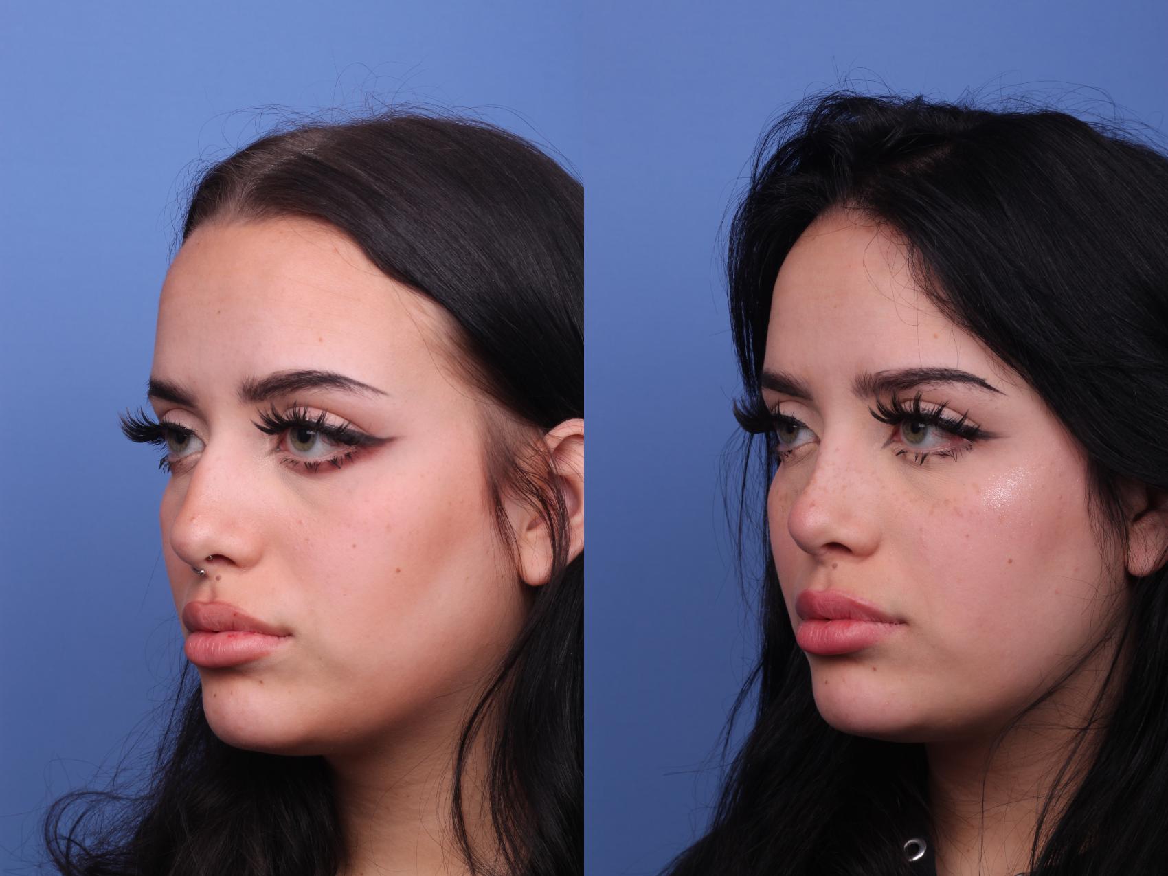 Before & After Rhinoplasty Case 450 Left Oblique View in Scottsdale, AZ