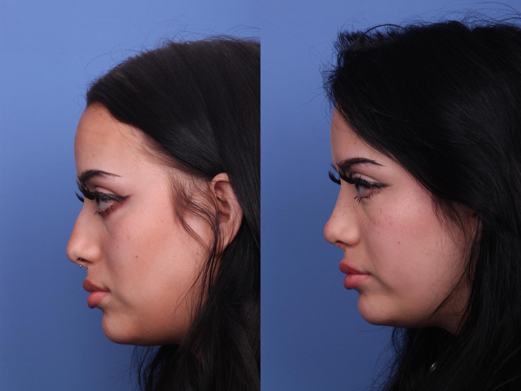 Before & After Rhinoplasty Case 450 Left Side View in Scottsdale, AZ