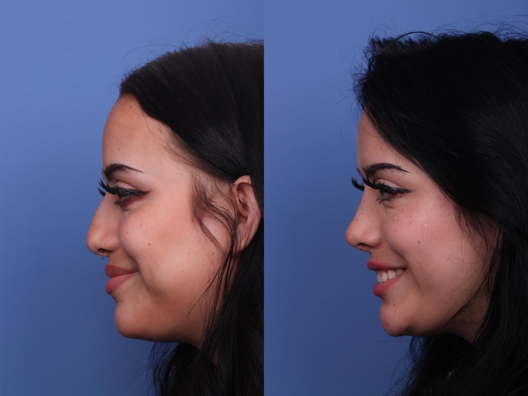 Before & After Rhinoplasty Case 450 Left Smile View in Scottsdale, AZ