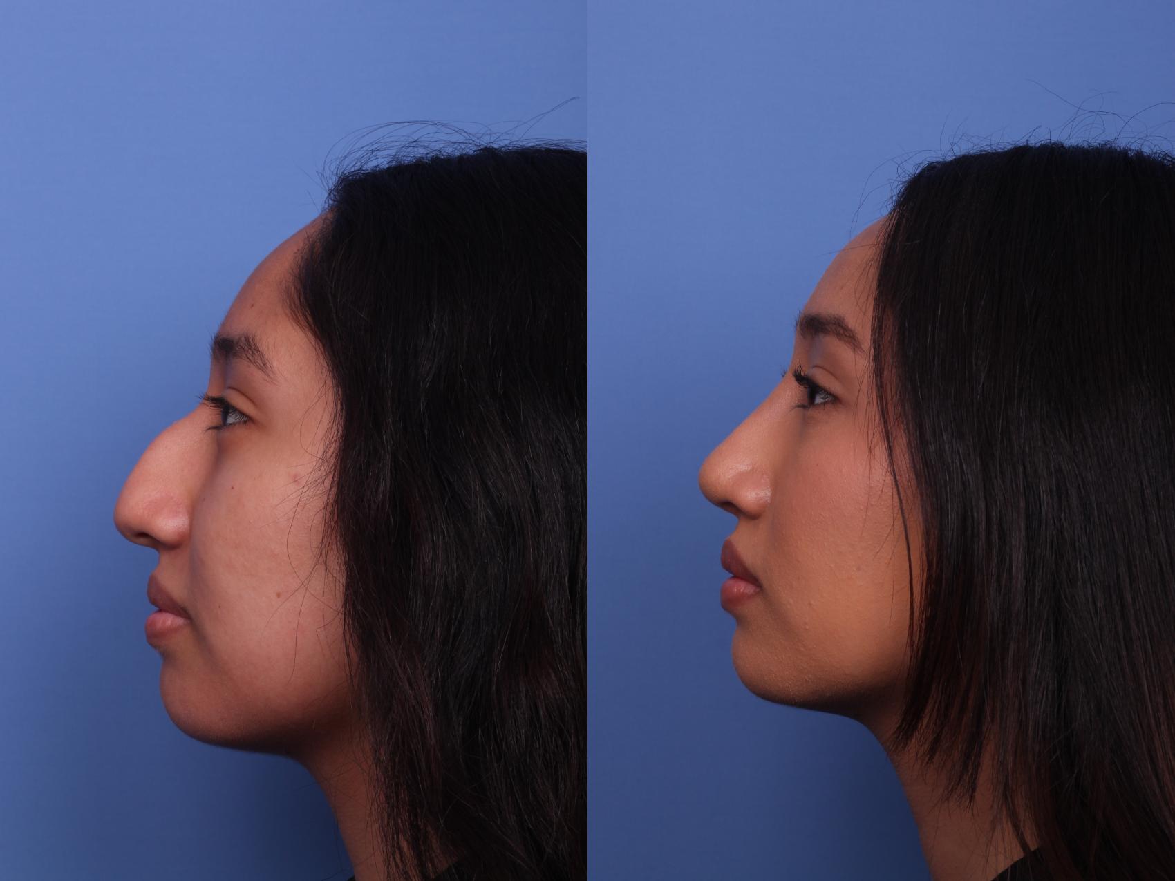 Before & After Rhinoplasty Case 451 Left Side View in Scottsdale, AZ