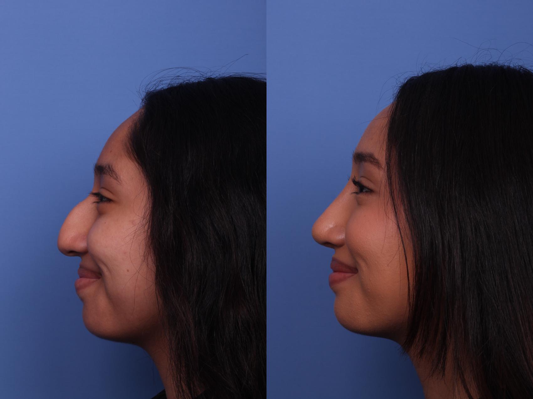 Before & After Rhinoplasty Case 451 Left Smile View in Scottsdale, AZ