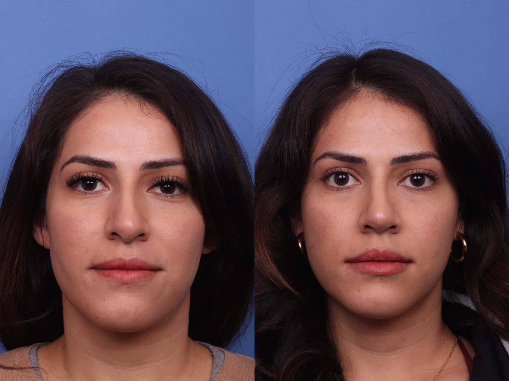 Before & After Rhinoplasty Case 455 Front View in Scottsdale, AZ