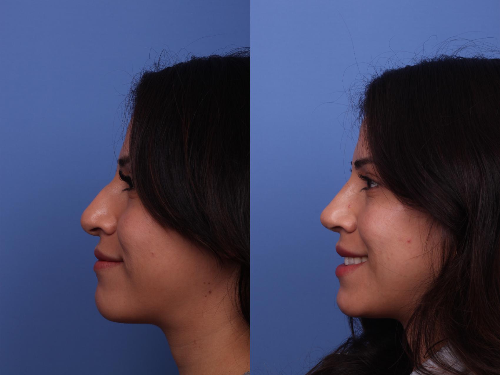 Before & After Rhinoplasty Case 455 Left Smile View in Scottsdale, AZ