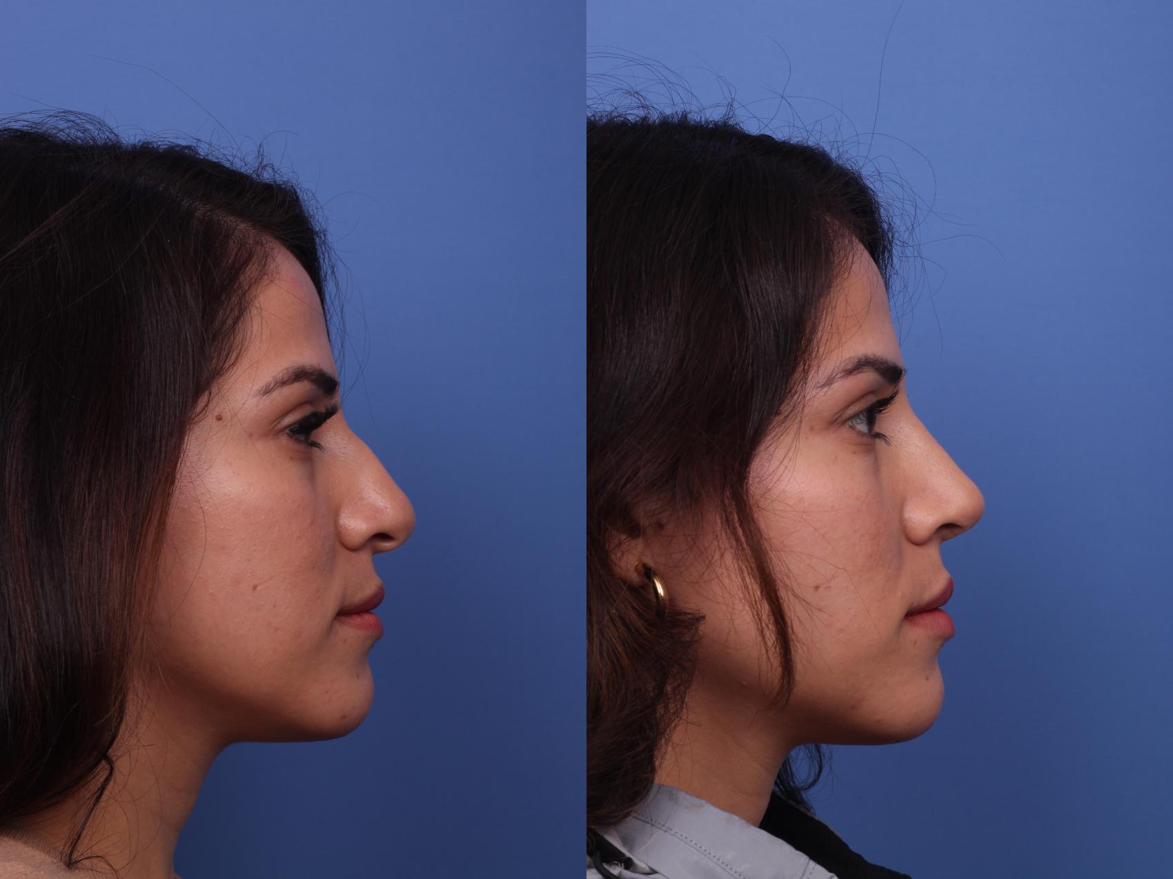 Before & After Rhinoplasty Case 455 Right Side View in Scottsdale, AZ