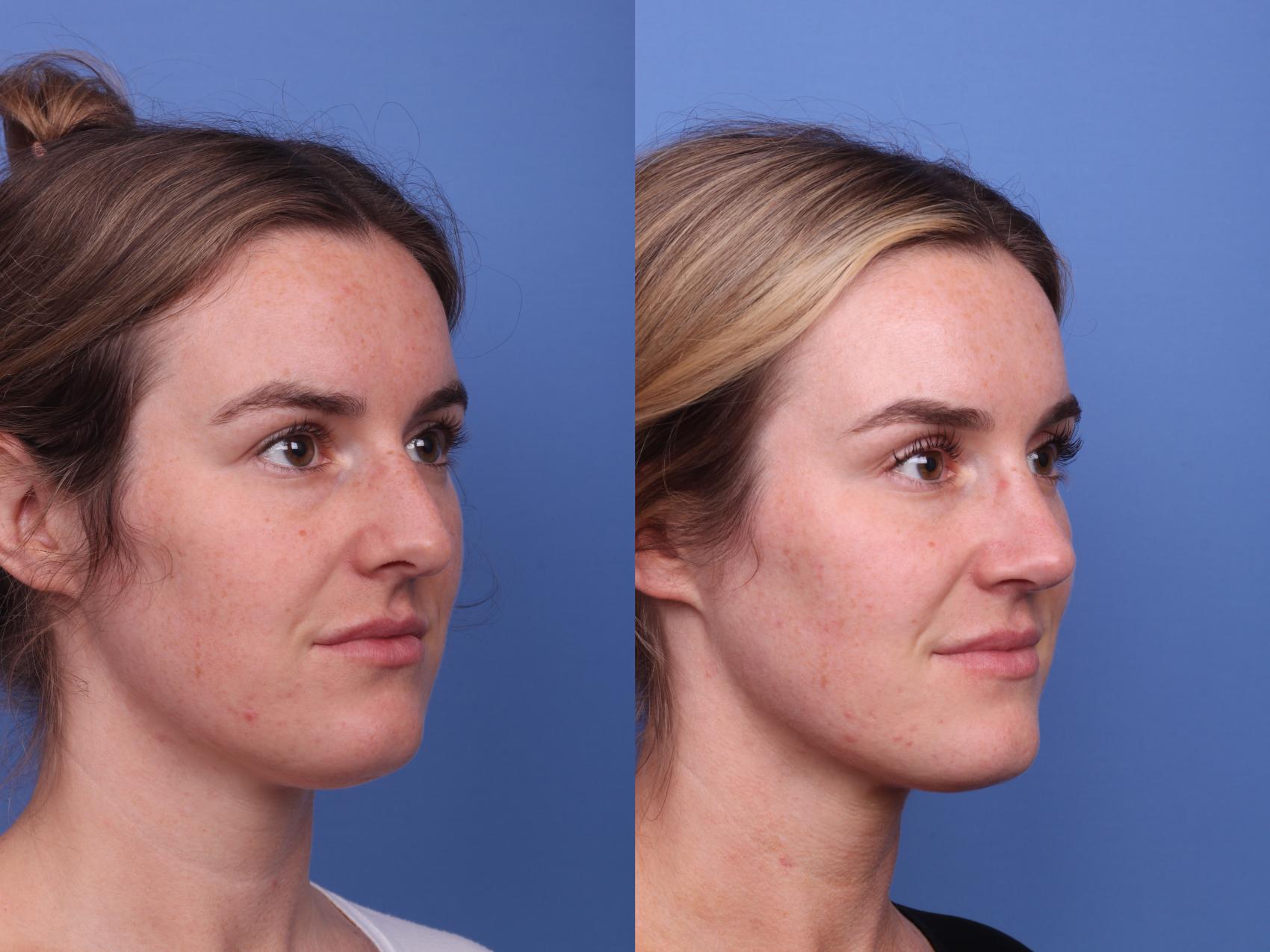 Before & After Rhinoplasty Case 458 Right Oblique View in Scottsdale, AZ