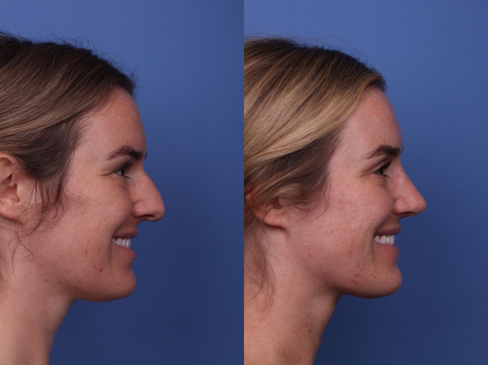 Before & After Rhinoplasty Case 458 Right Smile View in Scottsdale, AZ