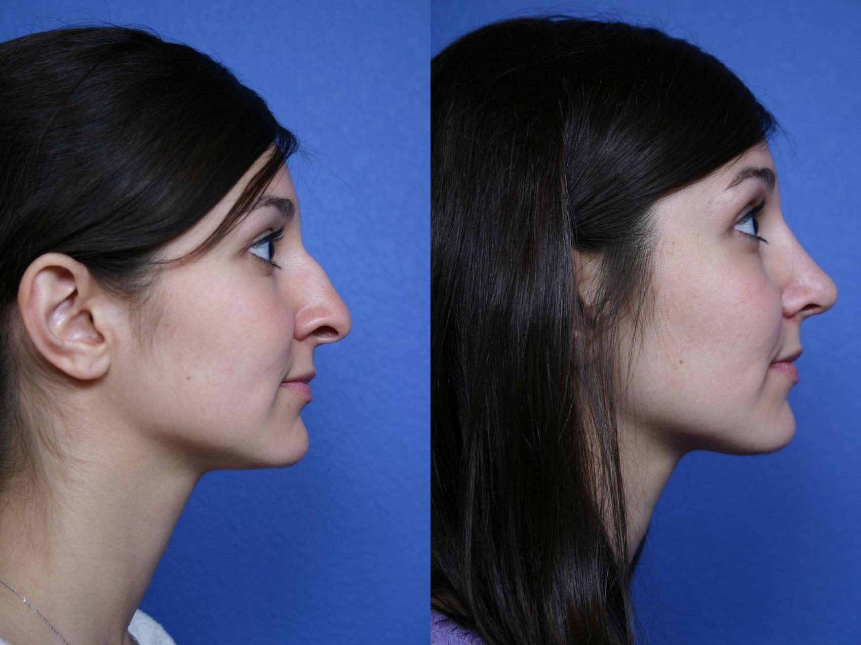Before & After Rhinoplasty Case 46 View #2 View in Scottsdale, AZ