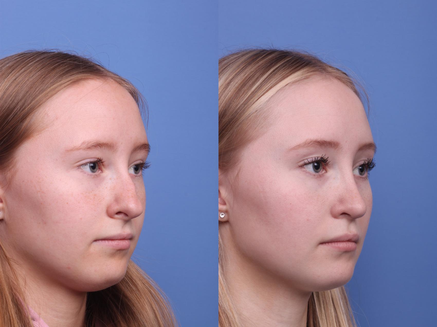 Before & After Rhinoplasty Case 462 Right Oblique View in Scottsdale, AZ