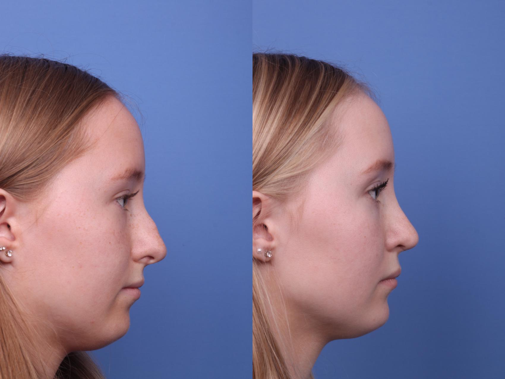 Before & After Rhinoplasty Case 462 Right Side View in Scottsdale, AZ