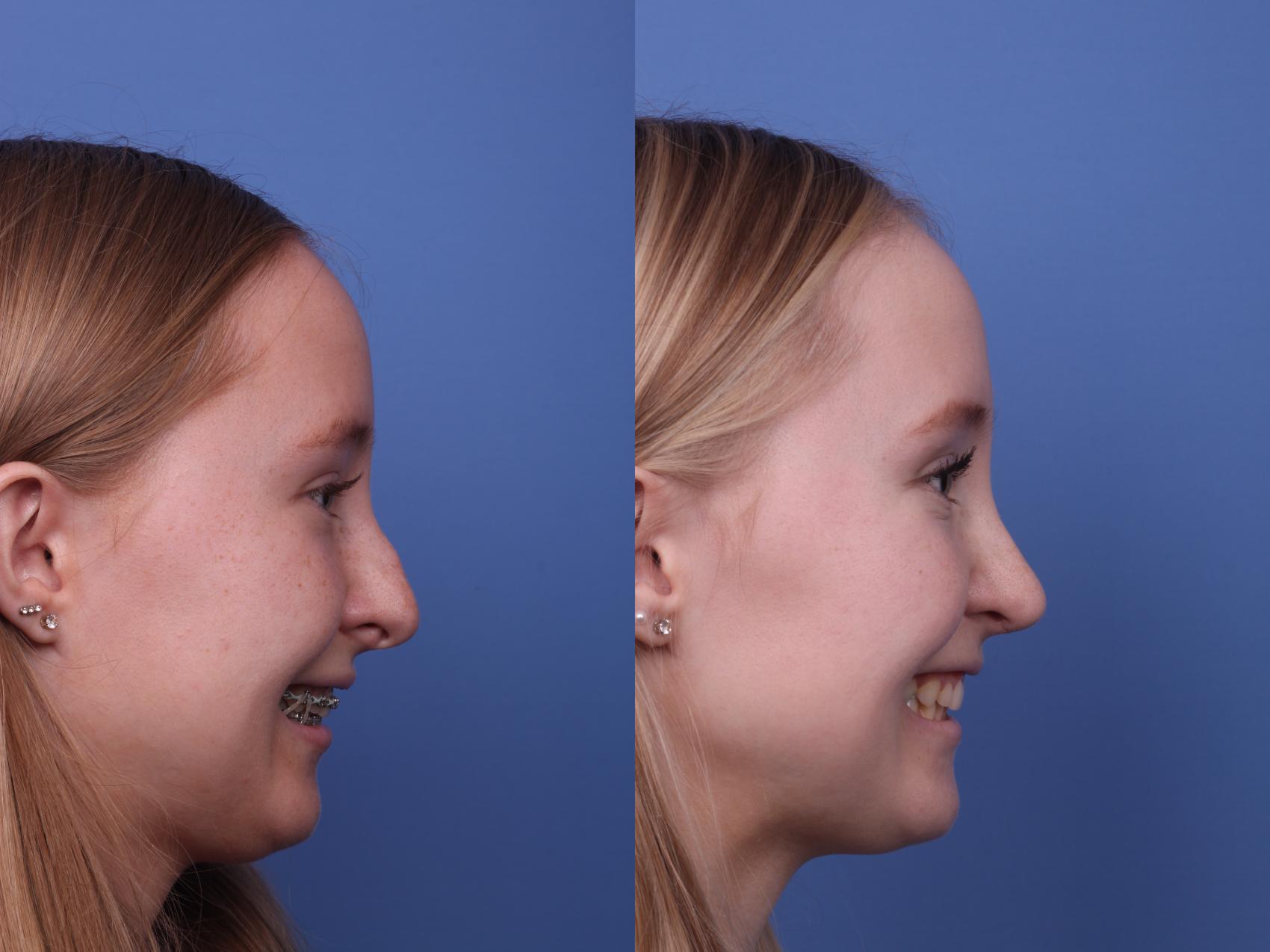 Before & After Rhinoplasty Case 462 Right Smile View in Scottsdale, AZ
