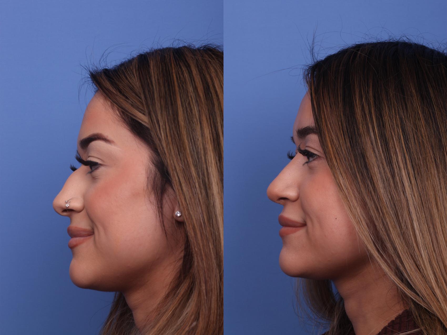 Before & After Rhinoplasty Case 463 Left Smile View in Scottsdale, AZ