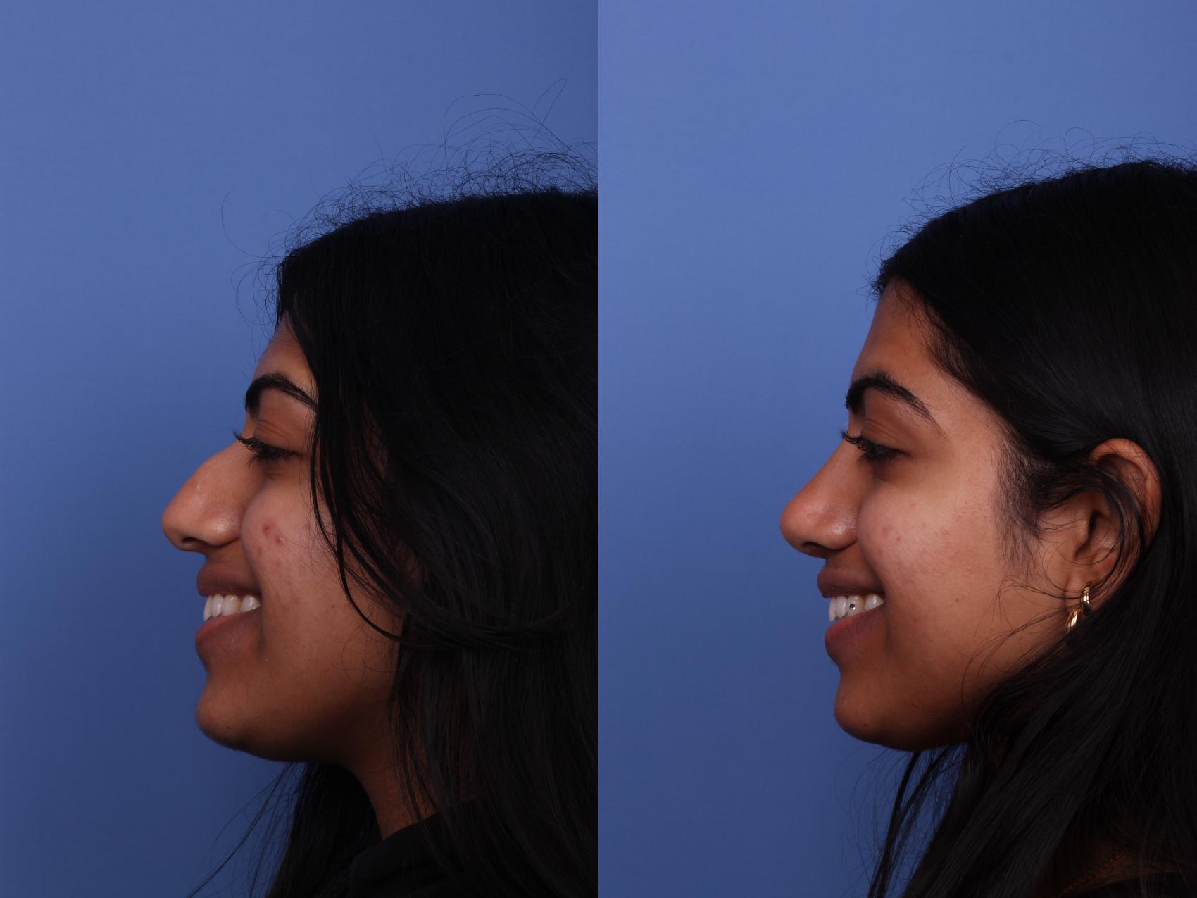 Before & After Rhinoplasty Case 464 Left Smile View in Scottsdale, AZ