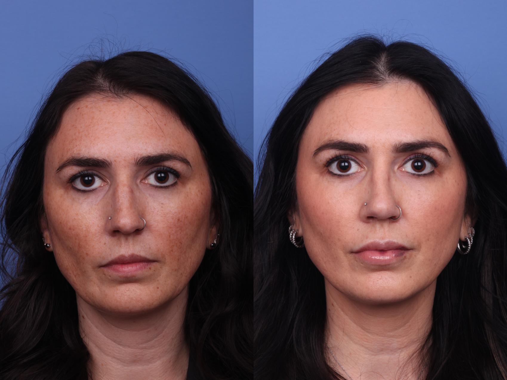 Before & After Rhinoplasty Case 466 Front View in Scottsdale, AZ