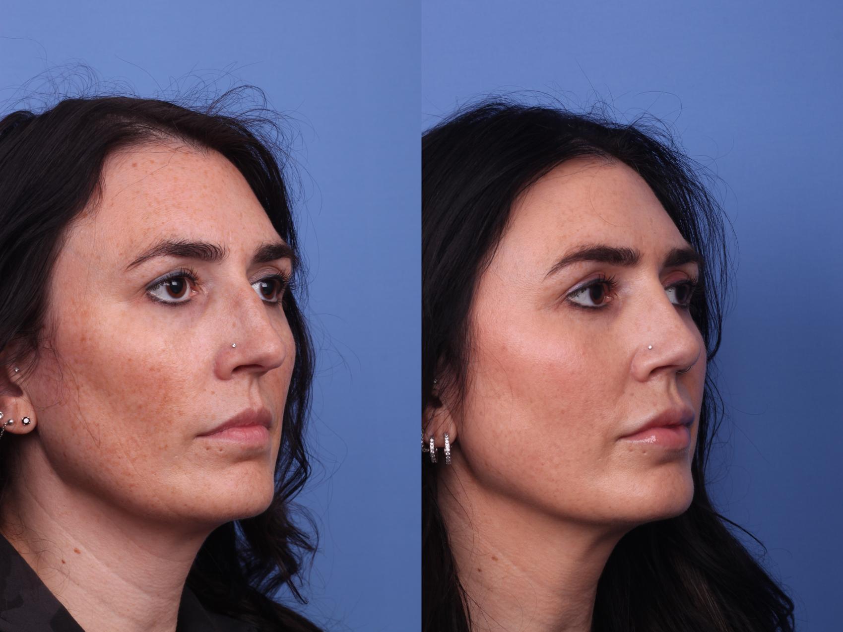 Before & After Rhinoplasty Case 466 Right Oblique View in Scottsdale, AZ