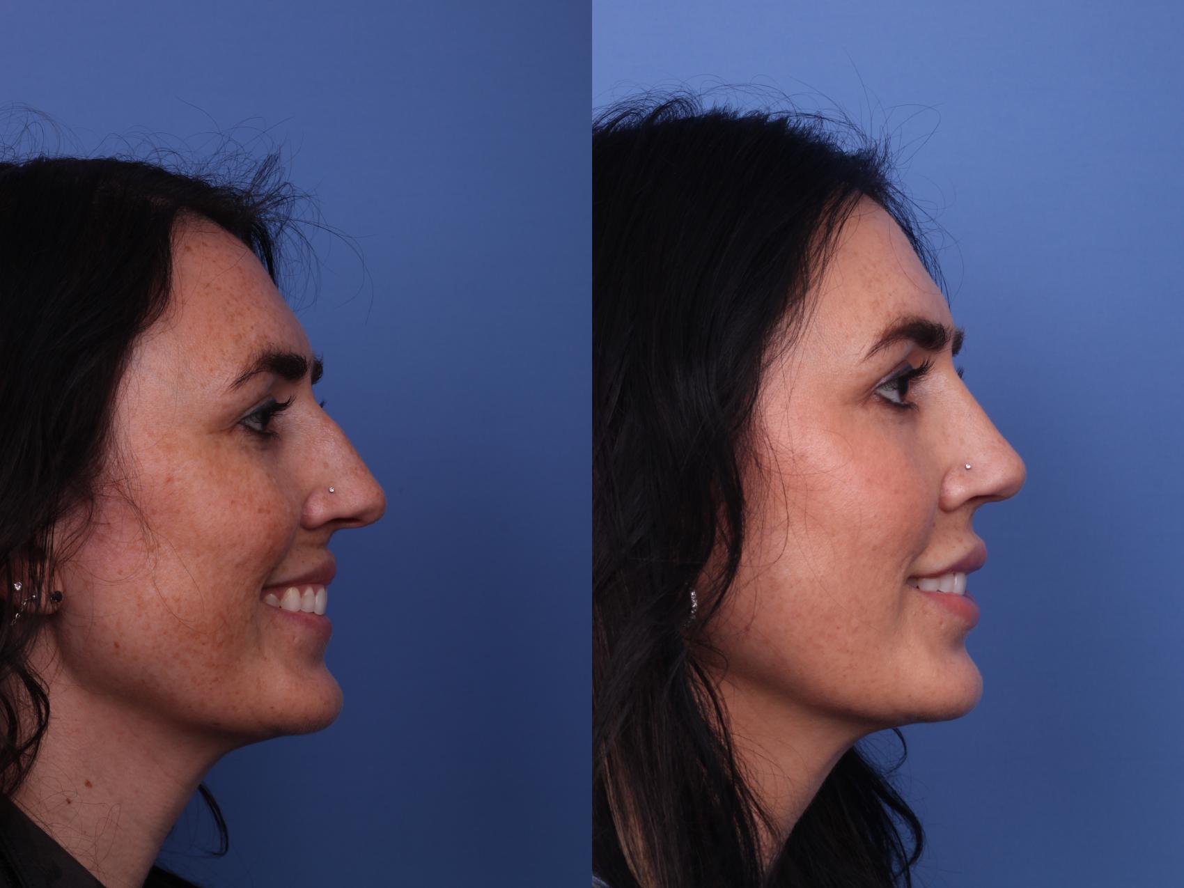 Before & After Rhinoplasty Case 466 Right Smile View in Scottsdale, AZ