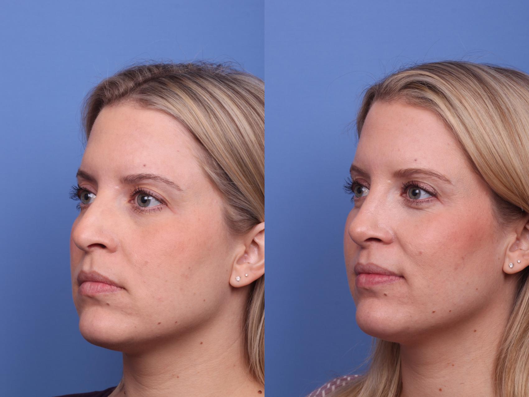 Before & After Rhinoplasty Case 469 Left Oblique View in Scottsdale, AZ