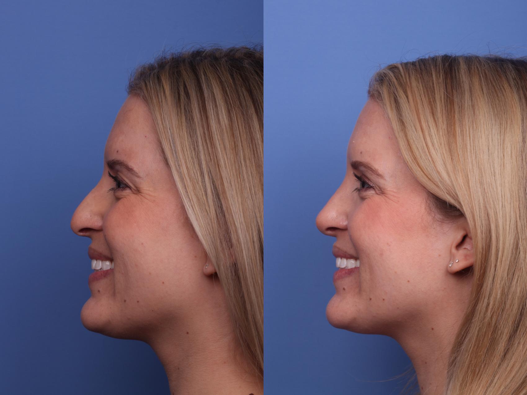 Before & After Rhinoplasty Case 469 Left Smile View in Scottsdale, AZ