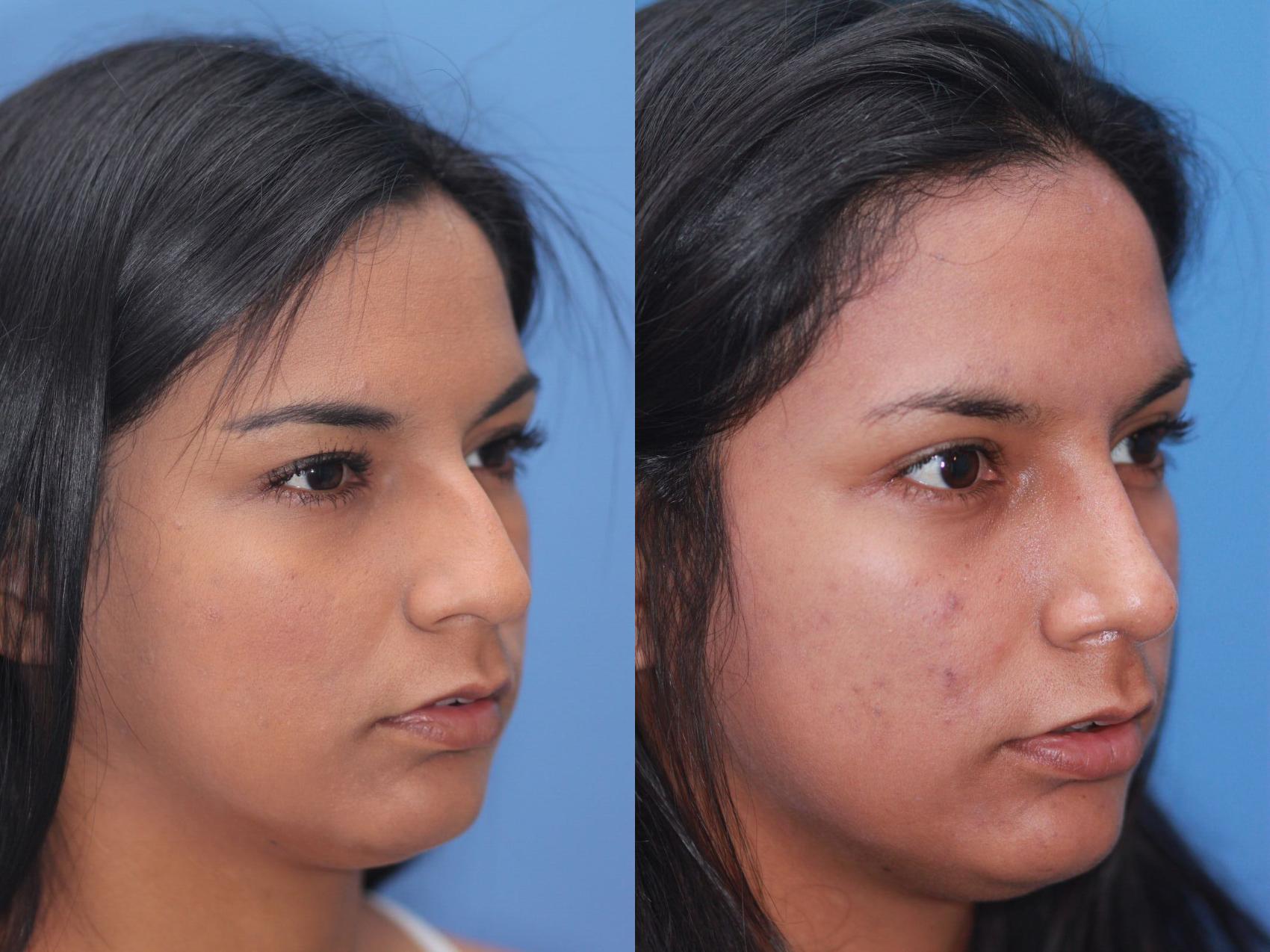 Before & After Rhinoplasty Case 47 View #2 View in Scottsdale, AZ
