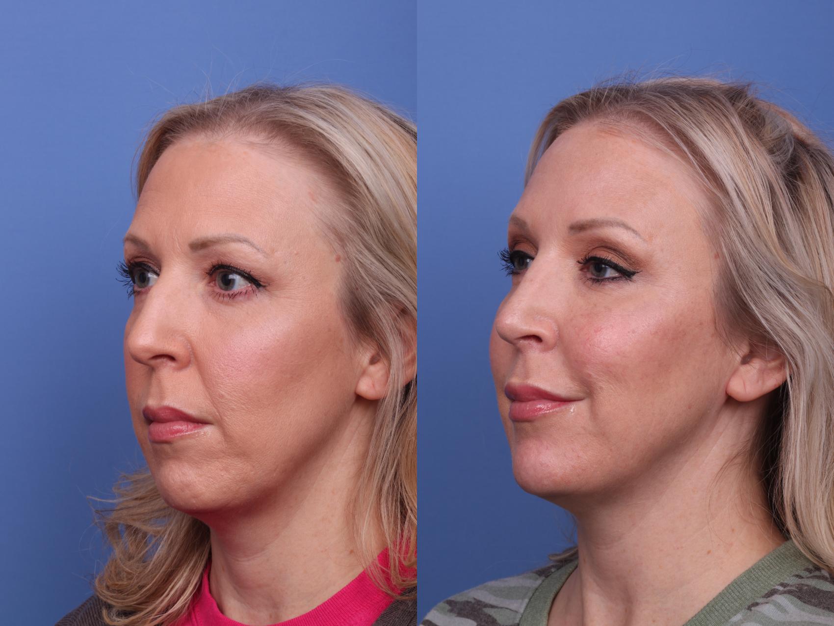 Before & After Rhinoplasty Case 471 Left Oblique View in Scottsdale, AZ