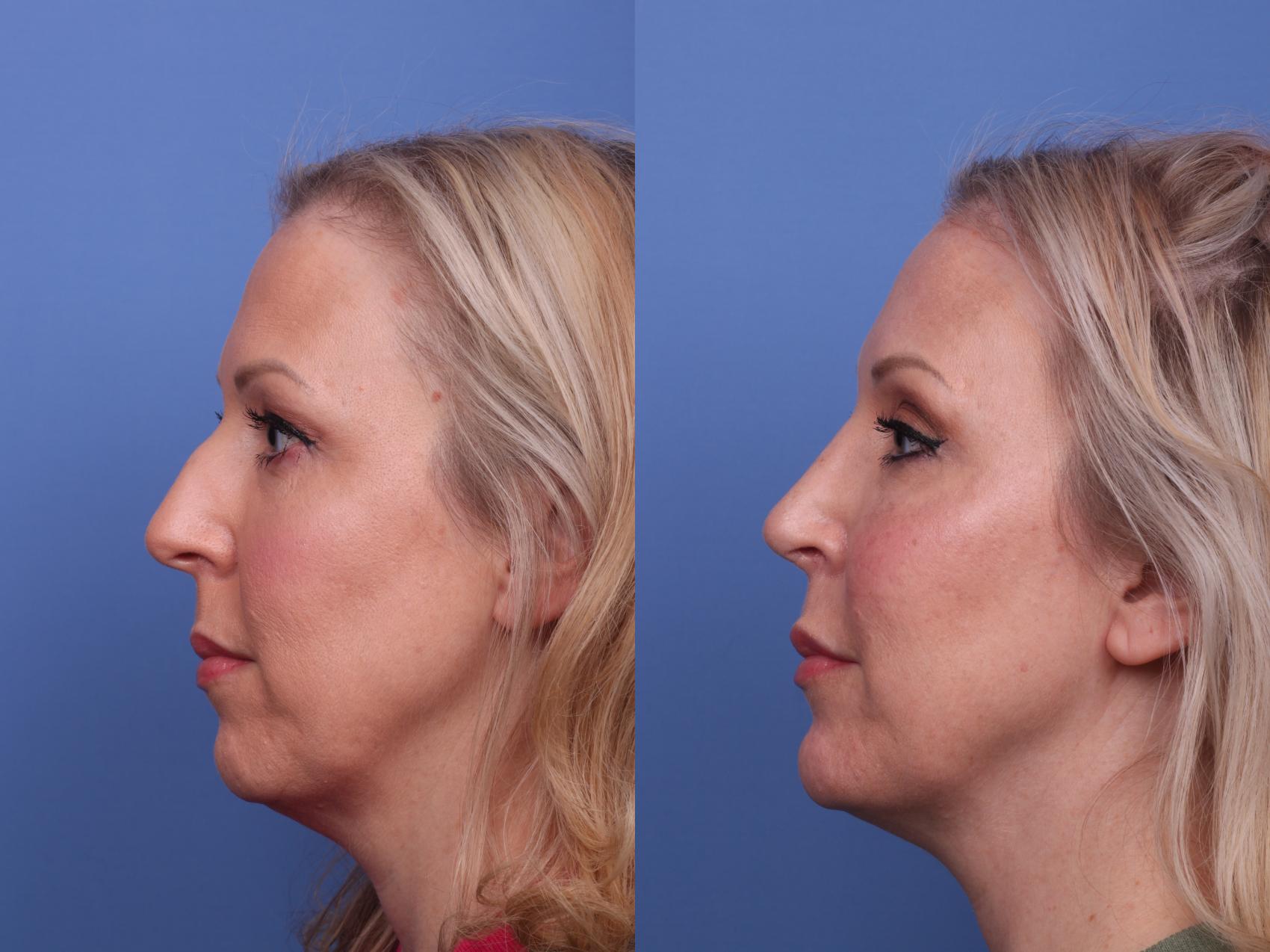 Before & After Rhinoplasty Case 471 Left Side View in Scottsdale, AZ