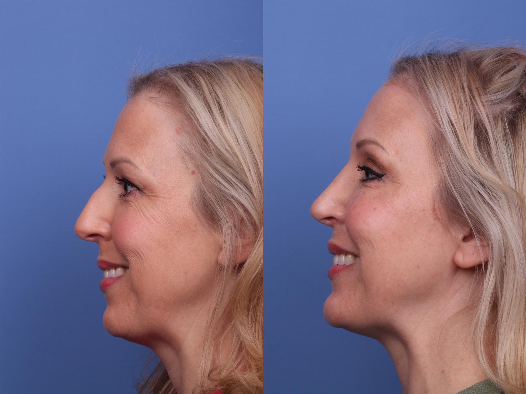 Before & After Rhinoplasty Case 471 Left Smile View in Scottsdale, AZ