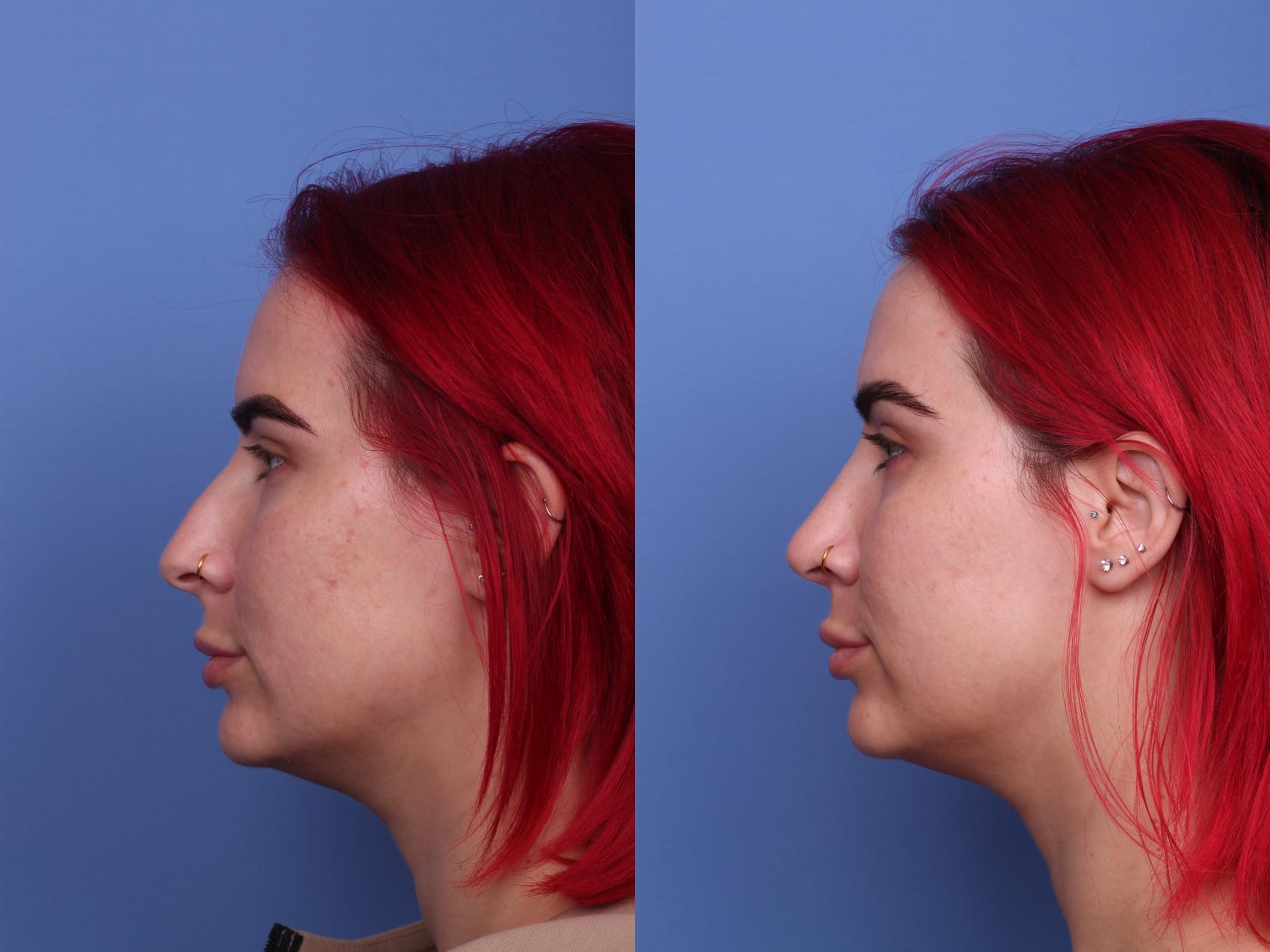Before & After Rhinoplasty Case 474 Left Side View in Scottsdale, AZ