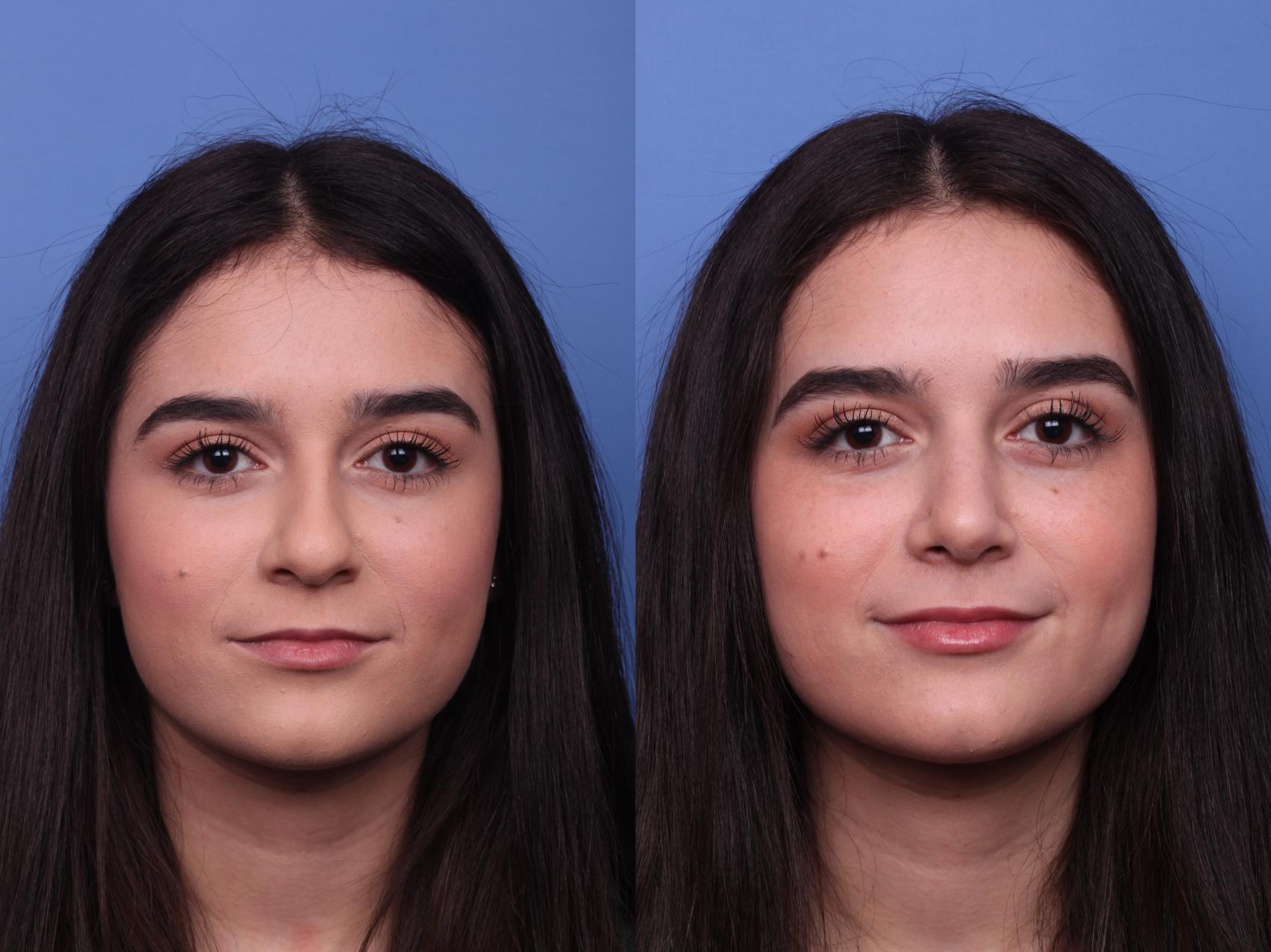 Before & After Rhinoplasty Case 476 Front View in Scottsdale, AZ