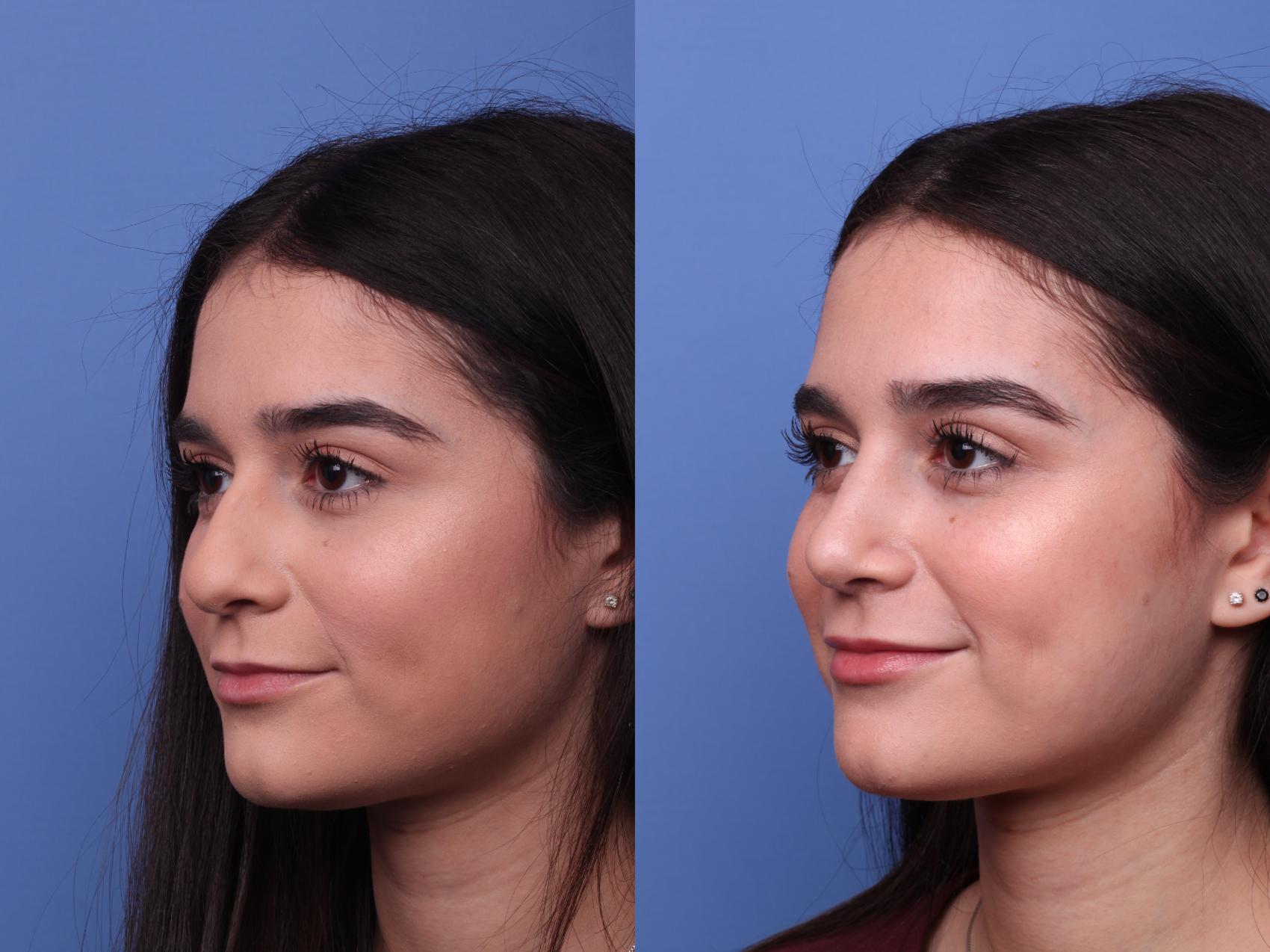 Before & After Rhinoplasty Case 476 Left Oblique View in Scottsdale, AZ
