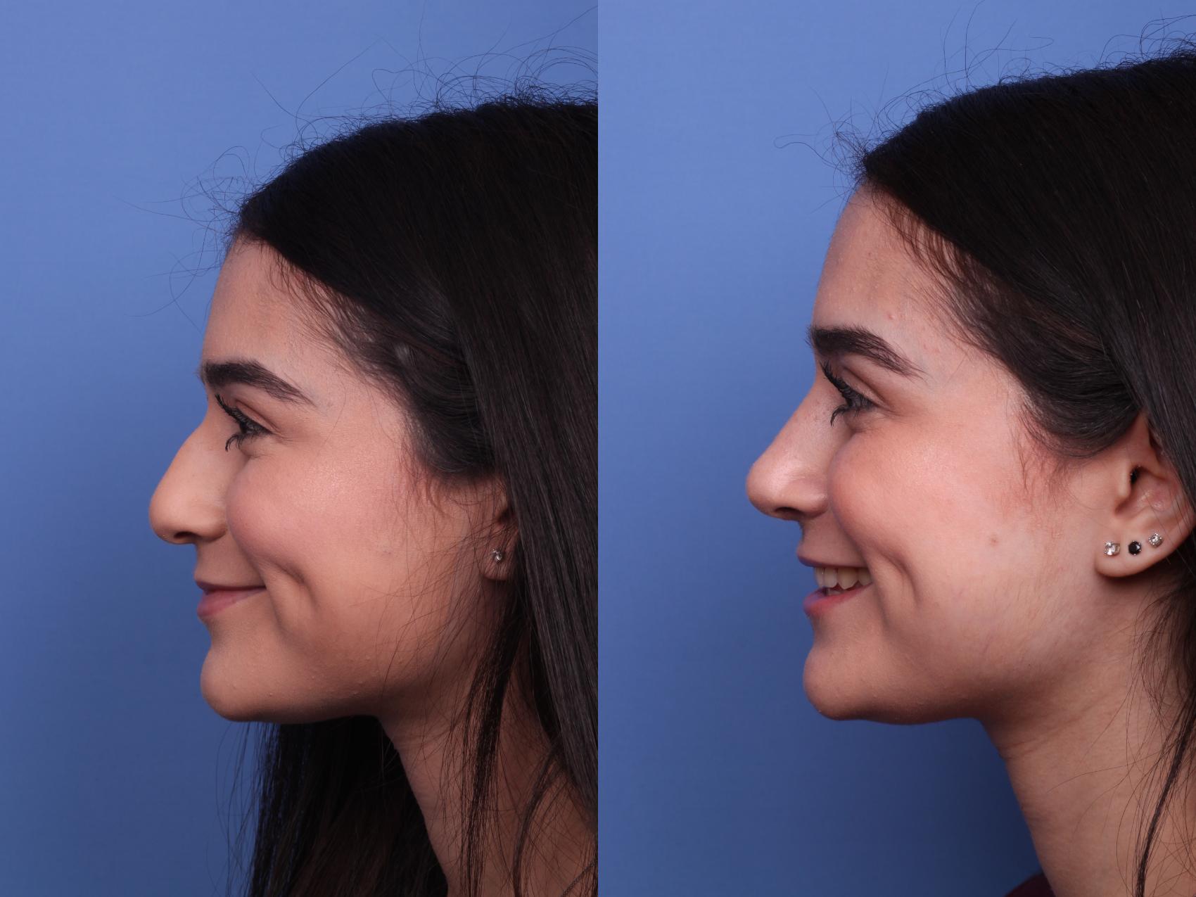 Before & After Rhinoplasty Case 476 Left Smile View in Scottsdale, AZ