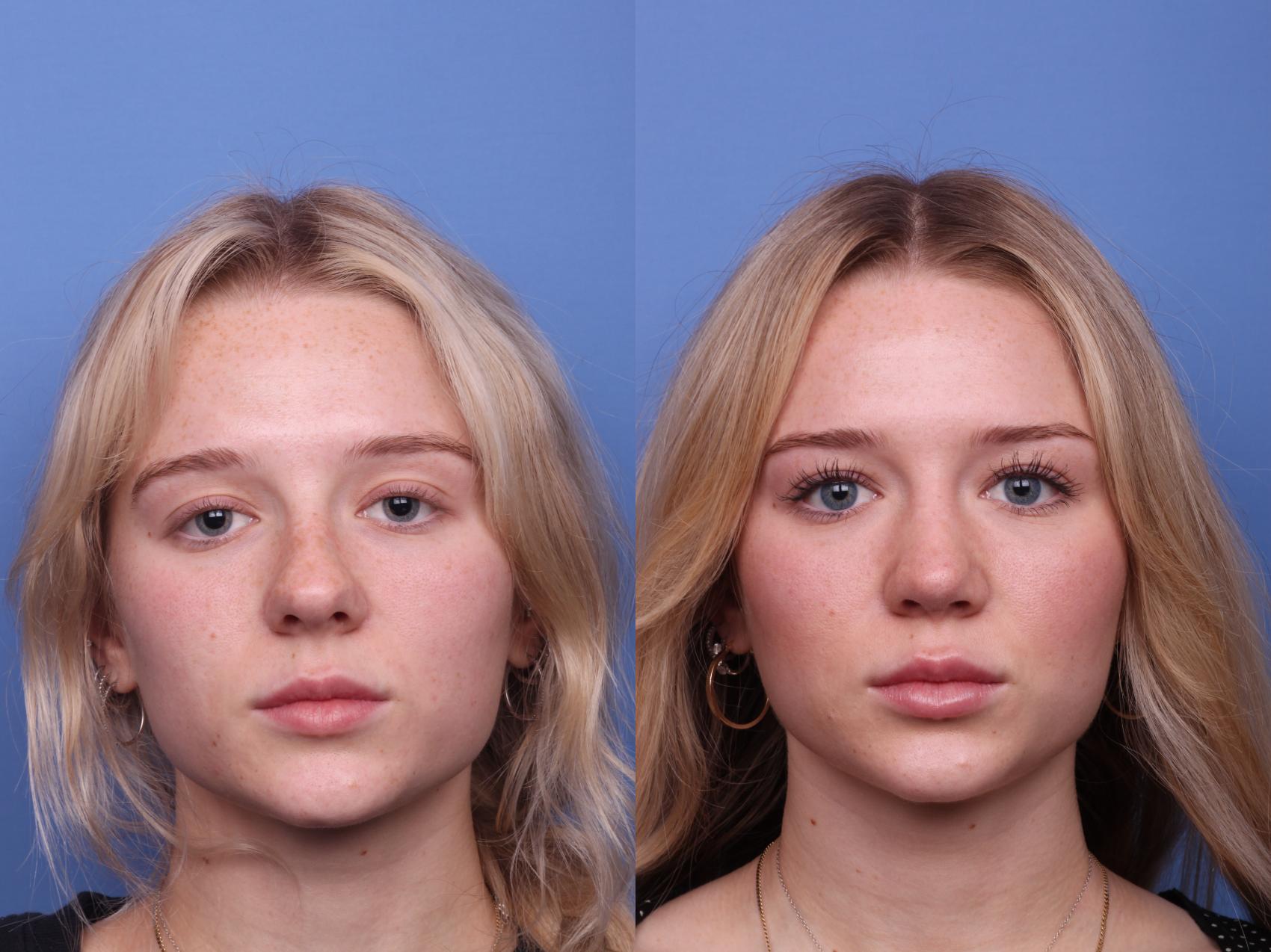 Before & After Rhinoplasty Case 479 Front View in Scottsdale, AZ