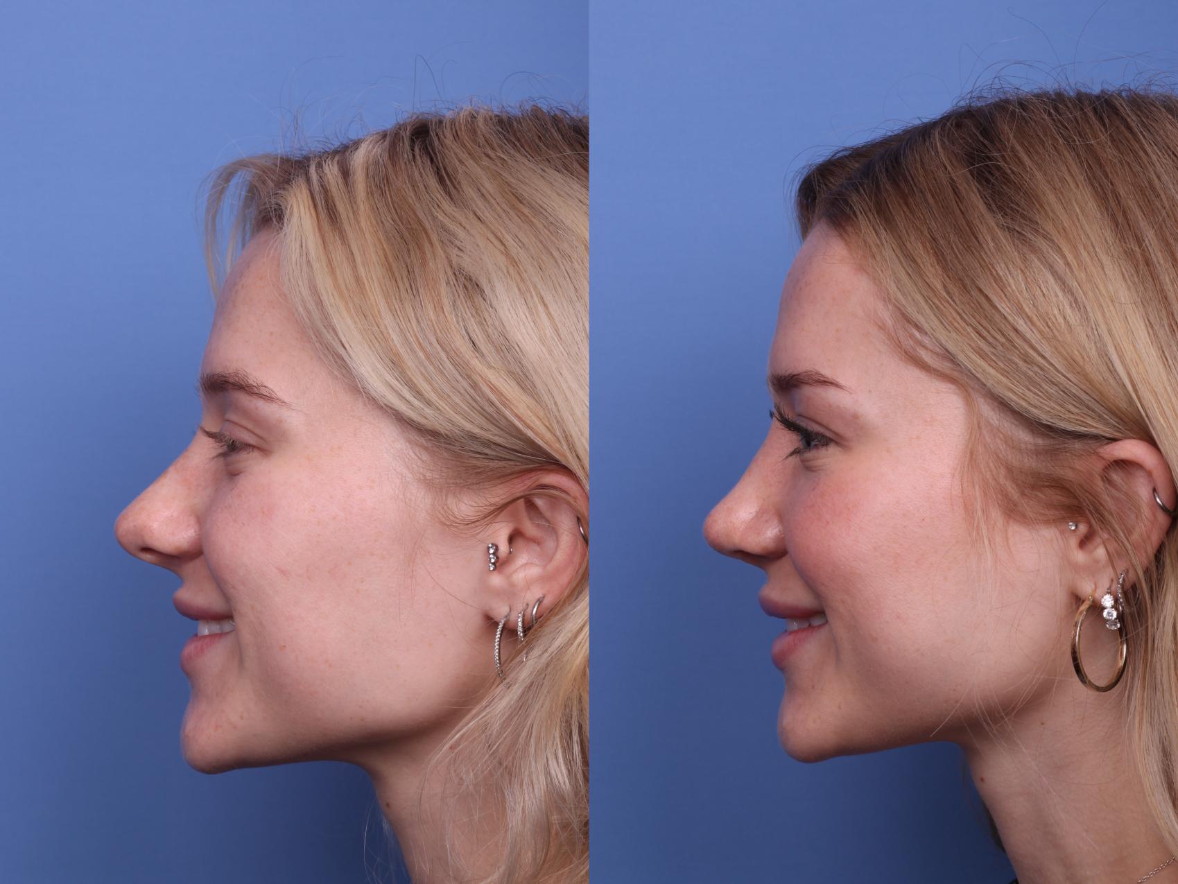 Before & After Rhinoplasty Case 479 Left Smile View in Scottsdale, AZ
