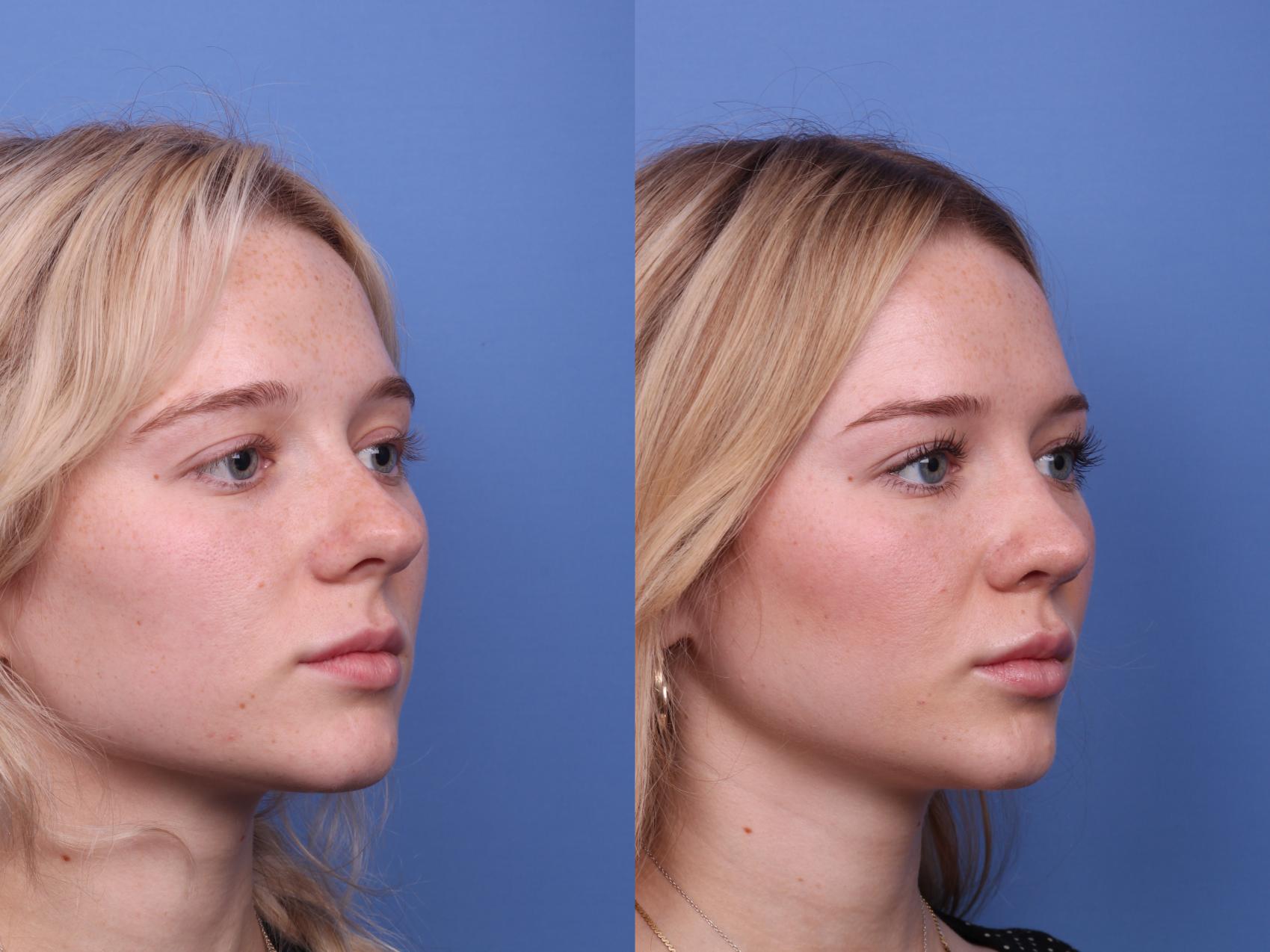 Before & After Rhinoplasty Case 479 Right Oblique View in Scottsdale, AZ