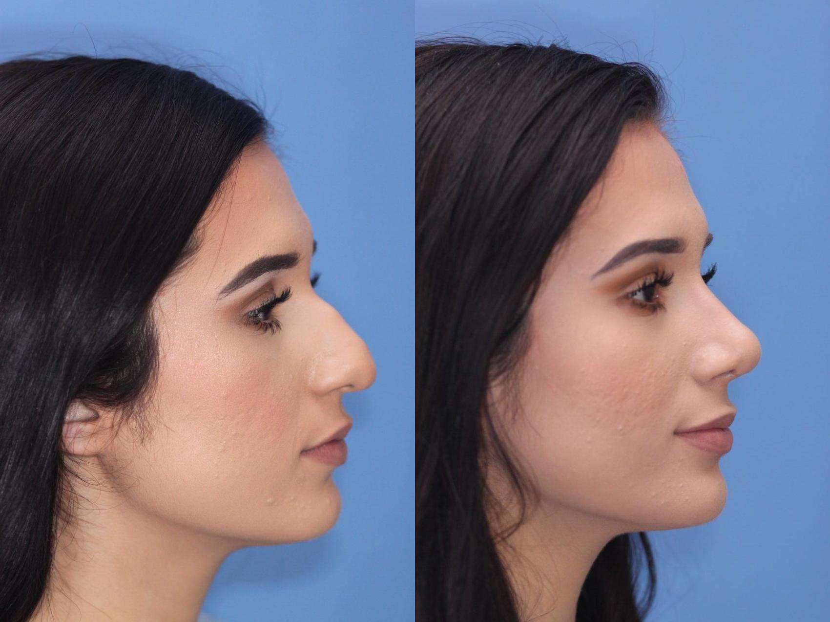 Before & After Rhinoplasty Case 48 View #2 View in Scottsdale, AZ