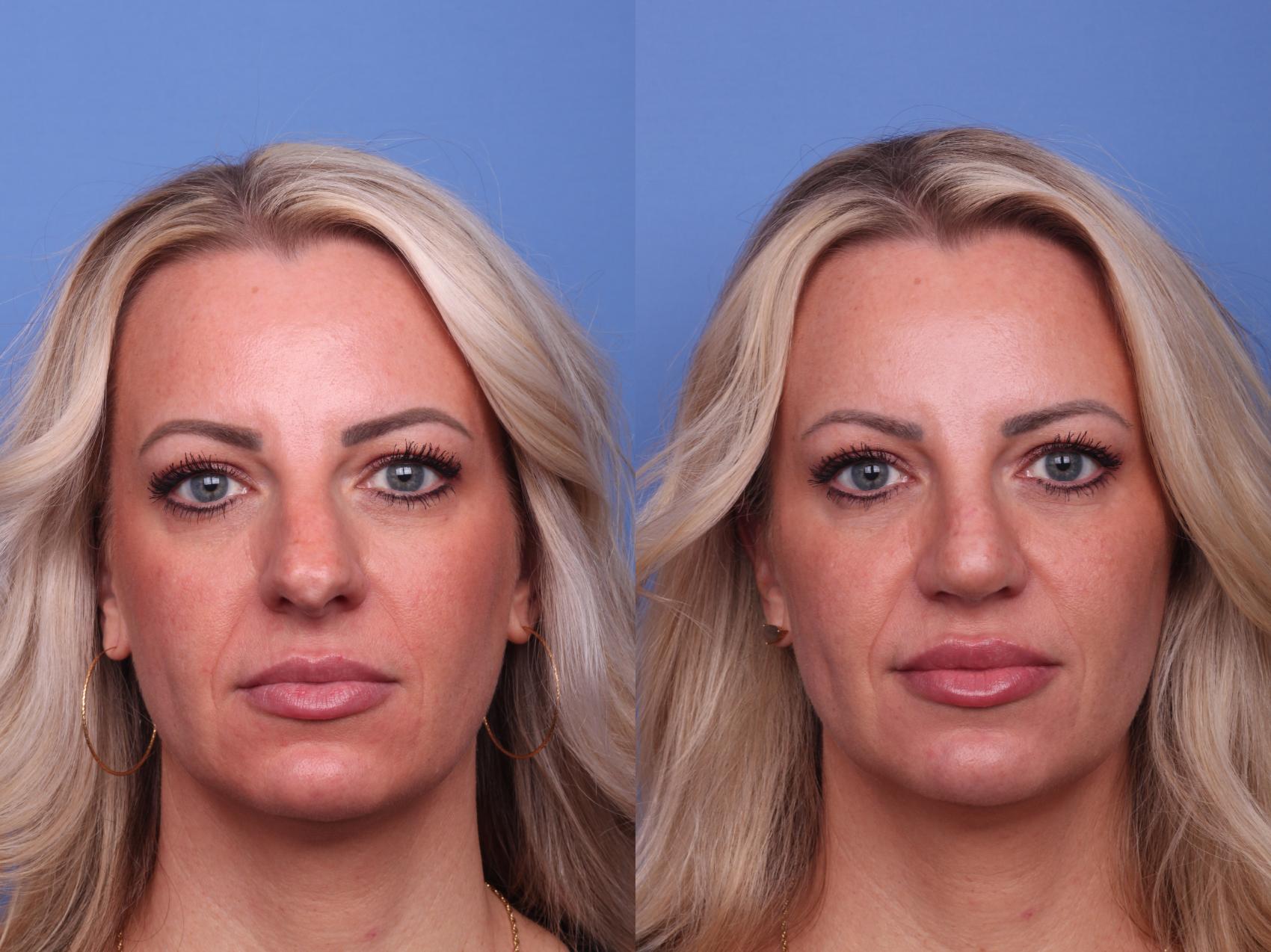 Before & After Rhinoplasty Case 480 Front View in Scottsdale, AZ
