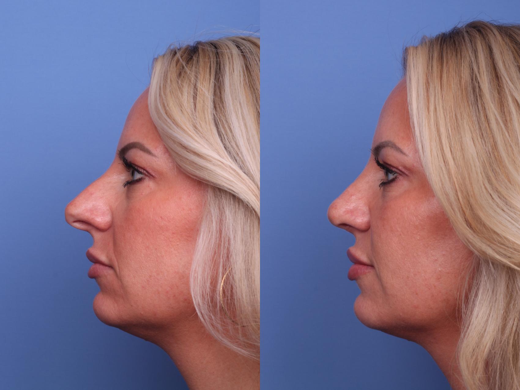 Before & After Rhinoplasty Case 480 Left Side View in Scottsdale, AZ