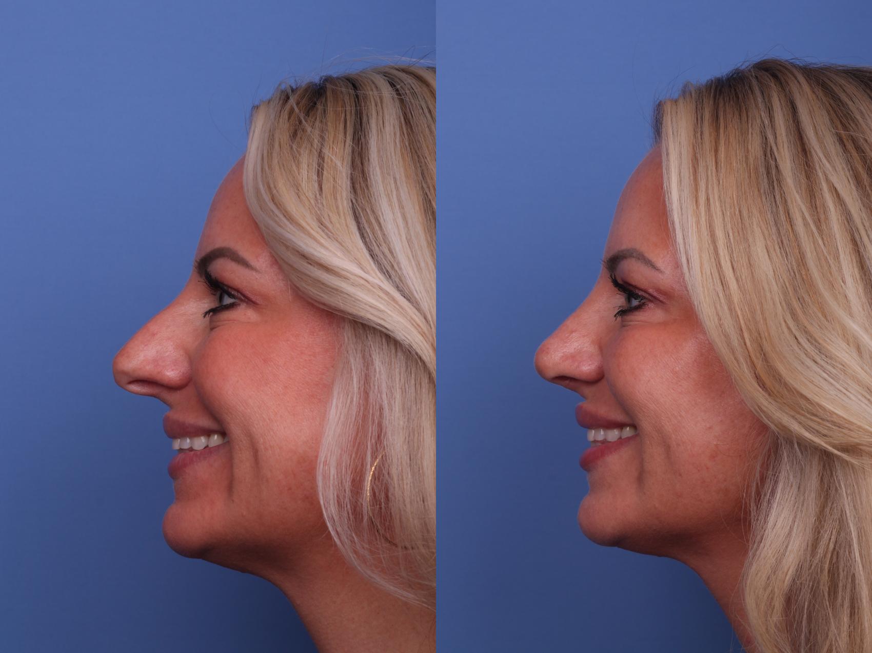 Before & After Rhinoplasty Case 480 Left Smile View in Scottsdale, AZ