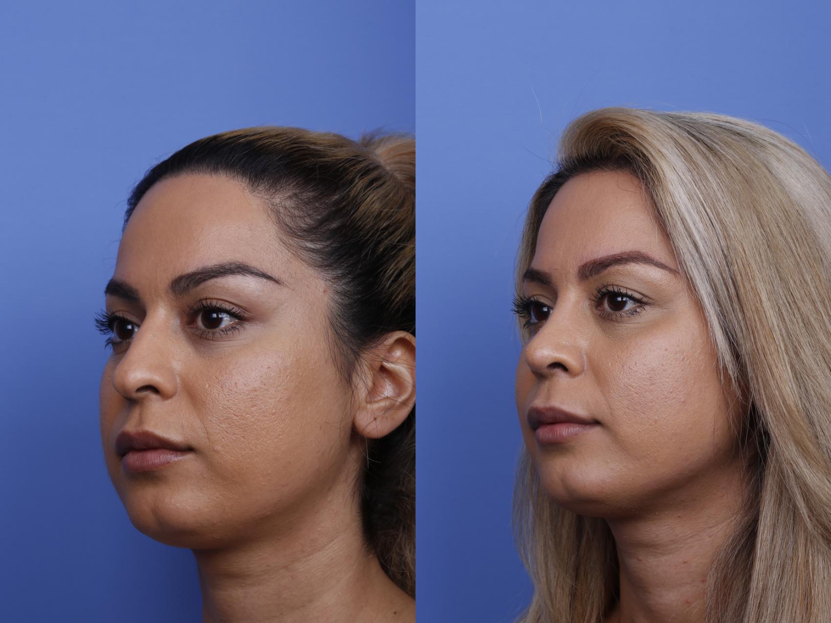 Before & After Rhinoplasty Case 481 Left Oblique View in Scottsdale, AZ